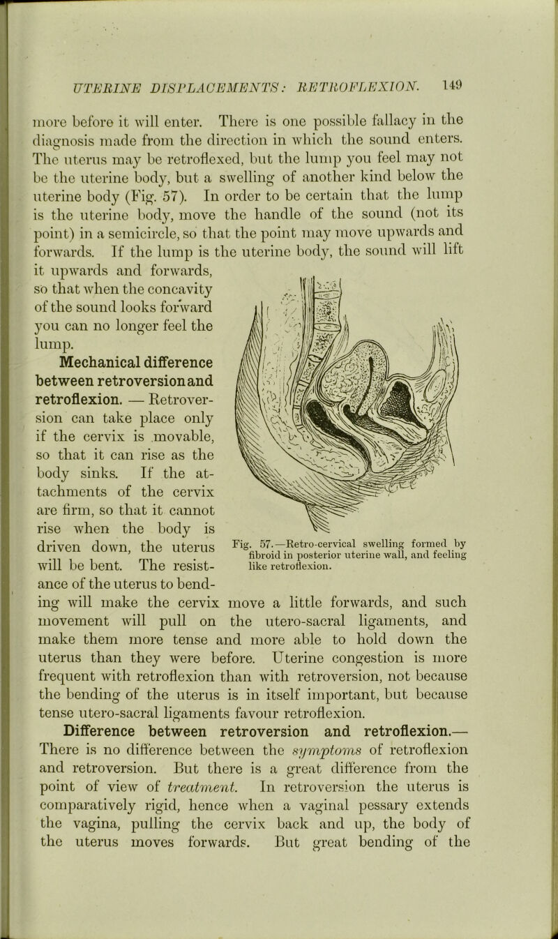 more before it will enter. There is one possible fallacy in the diao’nosis made from the direction in which the sound enters, O The uterus may he retroflexed, but the lump you feel may not be the uterine body, but a swelling of another kind below the uterine body (Fig. 57). In order to be certain that the lump is the uterine body, move the handle of the sound (not its point) in a semicircle, so that the point may move upwards and forwards. If the lump is the uterine body, the sound will lift it upwards and forwards, so that when the concavity of the sound looks forward you can no longer feel the lump. Mechanical difference between retroversion and retroflexion. — Retrover- sion can take place only if the cervix is movable, so that it can rise as the body sinks. If the at- tachments of the cervix are firm, so that it cannot rise when the body is driven down, the uterus will be bent. The resist- ance of the uterus to bend- ing will make the cervix move a little forwards, and such movement will pull on the utero-sacral ligaments, and make them more tense and more able to hold down the uterus than they were before. Uterine congestion is more frequent with retroflexion than with retroversion, not because the bending of the uterus is in itself important, but because tense utero-sacral ligaments favour retroflexion. Difference between retroversion and retroflexion.— There is no difference between the symptoms of retroflexion and retroversion. But there is a great difference from the point of view of treatment. In retroversion the uterus is comparatively rigid, hence when a vaginal pessary extends the vagina, pulling the cervix back and up, the body of the uterus moves forwards. Bat great bending of the Fig. 57.—Retro-cervical swelling formed by fibroid in j)osterior uterine wall, and feeling like retroflexion.