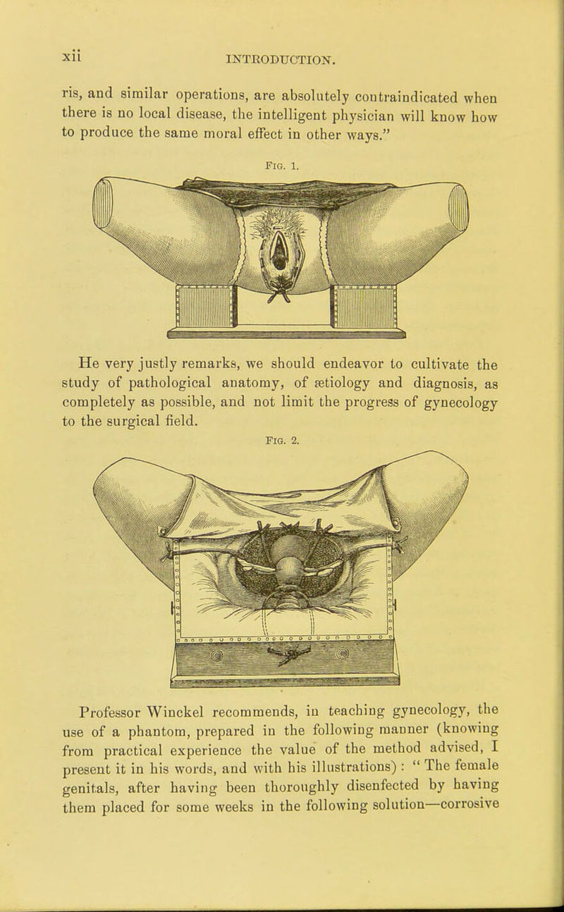 ris, and similar operations, are absolutely contraindicated when there is no local disease, the intelligent physician will know how to produce the same moral effect in other ways. Fig. 1. He very justly remarks, we should endeavor to cultivate the study of pathological anatomy, of aetiology and diagnosis, as completely as possible, and not limit the progress of gynecology to the surgical field. Fig. 2. Professor Winckel recommends, in teaching gynecology, the use of a phantom, prepared in the following manner (knowing from practical experience the value of the method advised, I present it in his words, and with his illustrations) :  The female genitals, after having been thoroughly disenfected by having them placed for some weeks in the following solution—corrosive