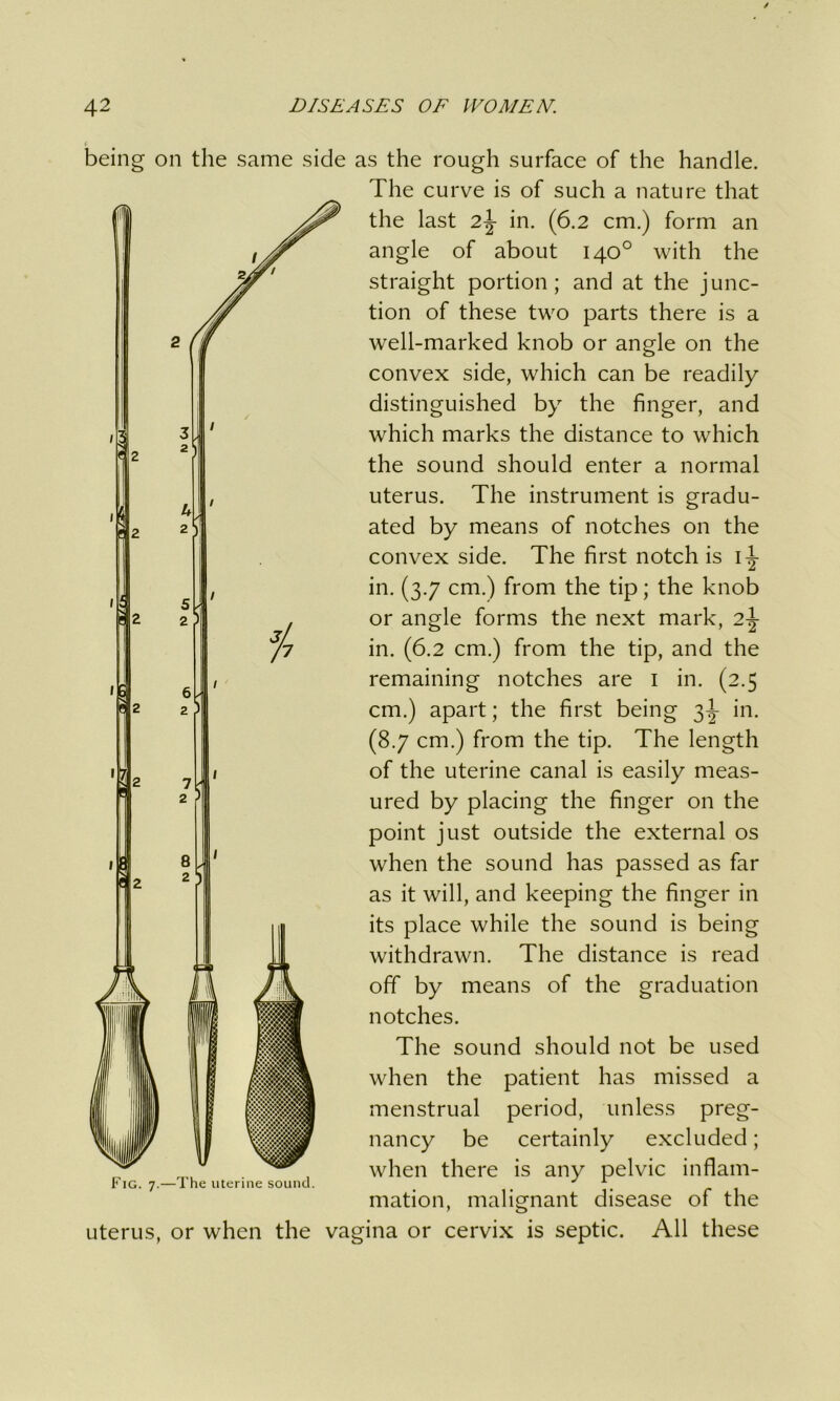 being on the same side as the rough surface of the handle. The curve is of such a nature that the last 2\ in. (6.2 cm.) form an angle of about 140° with the straight portion; and at the junc- tion of these two parts there is a well-marked knob or angle on the convex side, which can be readily distinguished by the finger, and which marks the distance to which the sound should enter a normal uterus. The instrument is gradu- ated by means of notches on the convex side. The first notch is 1^ in. (3.7 cm.) from the tip; the knob or angle forms the next mark, 2\ in. (6.2 cm.) from the tip, and the remaining notches are 1 in. (2.5 cm.) apart; the first being 3-^- in. (8.7 cm.) from the tip. The length of the uterine canal is easily meas- ured by placing the finger on the point just outside the external os when the sound has passed as far as it will, and keeping the finger in its place while the sound is being withdrawn. The distance is read off by means of the graduation notches. The sound should not be used when the patient has missed a menstrual period, unless preg- nancy be certainly excluded; when there is any pelvic inflam- mation, malignant disease of the uterus, or when the vagina or cervix is septic. All these Fig. 7.—The uterine sound.