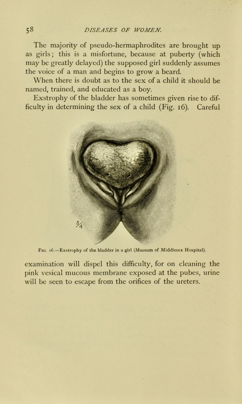 The majority of pseudo-hermaphrodites are brought up as girls; this is a misfortune, because at puberty (which may be greatly delayed) the supposed girl suddenly assumes the voice of a man and begins to grow a beard. When there is doubt as to the sex of a child it should be named, trained, and educated as a boy. Exstrophy of the bladder has sometimes given rise to dif- ficulty in determining the sex of a child (Fig. 16). Careful Fig. 16.—Exstrophy of the bladder in a girl (Museum of Middlesex Hospital). examination will dispel this difficulty, for on cleaning the pink vesical mucous membrane exposed at the pubes, urine will be seen to escape from the orifices of the ureters.