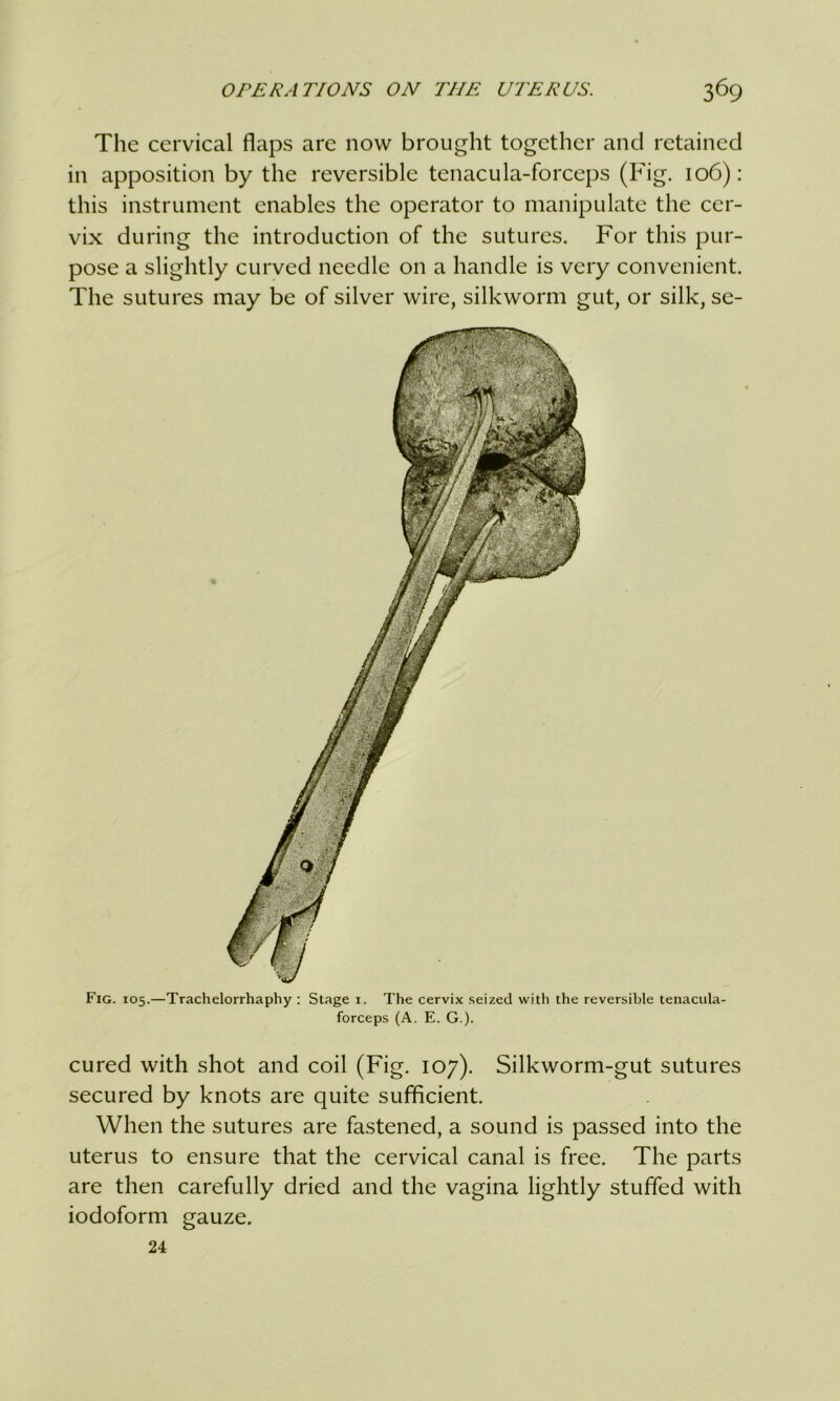 The cervical flaps are now brought together and retained in apposition by the reversible tenacula-forceps (Fig. 106): this instrument enables the operator to manipulate the cer- vix during the introduction of the sutures. For this pur- pose a slightly curved needle on a handle is very convenient. The sutures may be of silver wire, silkworm gut, or silk, se- Fig. 105.—Trachelorrhaphy : Stage i. The cervix seized with the reversible tenacula- forceps (A. E. G.). cured with shot and coil (Fig. 107). Silkworm-gut sutures secured by knots are quite sufficient. When the sutures are fastened, a sound is passed into the uterus to ensure that the cervical canal is free. The parts are then carefully dried and the vagina lightly stuffed with iodoform gauze. 24