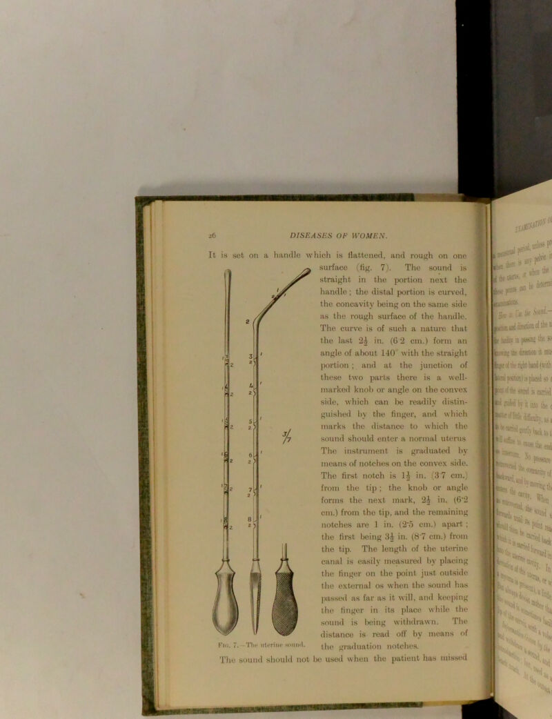 It is set on a Imnclle which is Hattened, and rough on one surface (tig. 7j. The sound is straight in the portion next the handle ; the distal portion is curved, the concavity being on the same side as the rough surface of the handle. The curve is of such a nature that the last 2h in. (0 2 cm.) form an angle of about 140° with the straight portion ; and at the junction of these two parts there is a well- marked knol) or angle on the convex side, which can l)e readily distin- guished by the finger, and which marks the distance to which the sound should enter a normal uterus The instrument is graduated by means of notches on the convex side. The first notch is in. (3 7 cm.) from tlie tip ; the knob or angle forms the next mark, 2^ in. (6'2 cm.) from the tip, and the remaining notches are 1 in. (2'5 cm.) apart ; the first being in. (8'7 cm.) from the tip. The length of the uterine canal is easily measured 1)V placing the finger on the ^joint just outside the external os when the sound has passed as far as it will, and keeping the finger in its place while the sound is i)eing withdrawn. The distance is read off by means of the graduation notches. * be (feteniir fcttis ca * I iSOSliiOBS. ia Mains 'i* ^ we liif ihe teofi if mu; iepMso a ^ snehi by it ijjo tb^ j The sound should not be used when the patient has missed ■■ ailMtilly. y a '*^»ndyi»ektotj until In mrt V 1^;.. ‘•sj- H. •'jnti