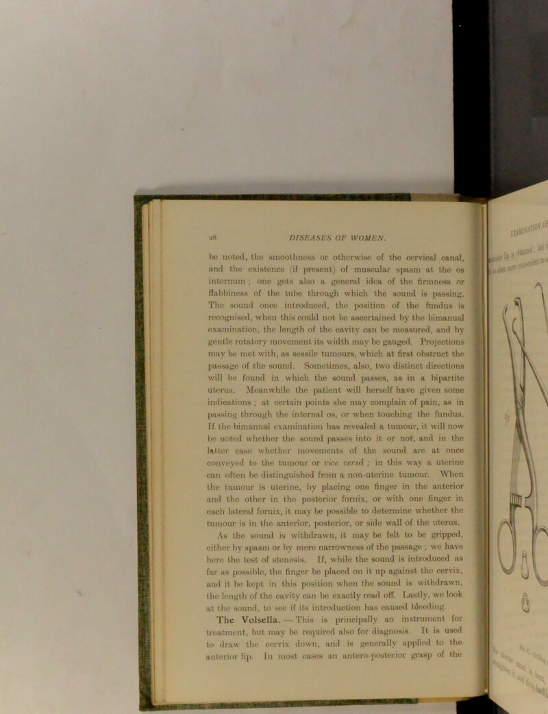 be noted, the smootlmess or otherwise of the cervical canal, and the existence (if present) of muscular spasm at the os internum ; one ffets also a f'eneral idea of the firmness or Halihiness of the tube throuf^h which the sound is passing. The sound once introduced, the position of the fundus is recognised, when this could not be ascertained liy the bimanual examination, the length of the cavity can be measured, and by gentle rotatory movement its width may be gauged. Projections may be met with, as sessile tumours, which at first obstinct the passage of the sound. Sometimes, also, two distinct directions will lie found in which the sound passes, as in a bipartite uterus. ^leanwhile the patient will herself have given some indications ; at certain points she may complain of pain, as in passing through the internal os, or when touching the fundus. If the bimanual examination has revealed a tumour, it will now be noted whether the sound passes into it or not, and in the latter case wliether movements of the sound are at once conveyed to the tumour or vice versa ; in this way a uterine can often be distinguished from a non-uterine tumour. When the tumour is uterine, by placing one finger in the anterior and the other in the posterior fornix, or with one finger in each lateral fornix, it may be possible to determine whether the tumour is in the anterior, posterior, or side wall of the uterus. .\s the sound is withdrawn, it may be felt to l)e gripped, eitlier by spasm or by mere naiTOwness of the passage ; we have here the test of stenosis. If, while the sound is introduced as far as possible, the finger l)e placed on it up against the cervix, and it he ke})t in this position when the sound is withdrawn, the length of the cavity can be exactly reiul off. Lastly, we look at the sound, to see if its introduction has caused Ideeding. The Volsella. — This is principally an instrument for treatment, but may bo required also for diagnosis. It is used to draw the cervix down, and is generally applied to the anterior lip. In most cases an antero-posterior gi-asp of the