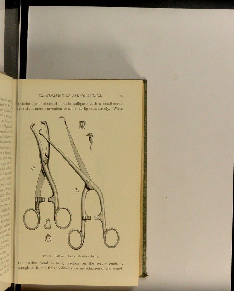 fte Smness a iinteinor lip is obtained ; but in nulliparte with a small cervix tt is often more convenient to seize the lip ti-ansversely. When Flo. 8.—Hiillilog volsi'lla; sk'niliir volsolla. the uterine canal is bent, traction on the cervix tends to straighten it, and thus facilitates the introduction of the sound.