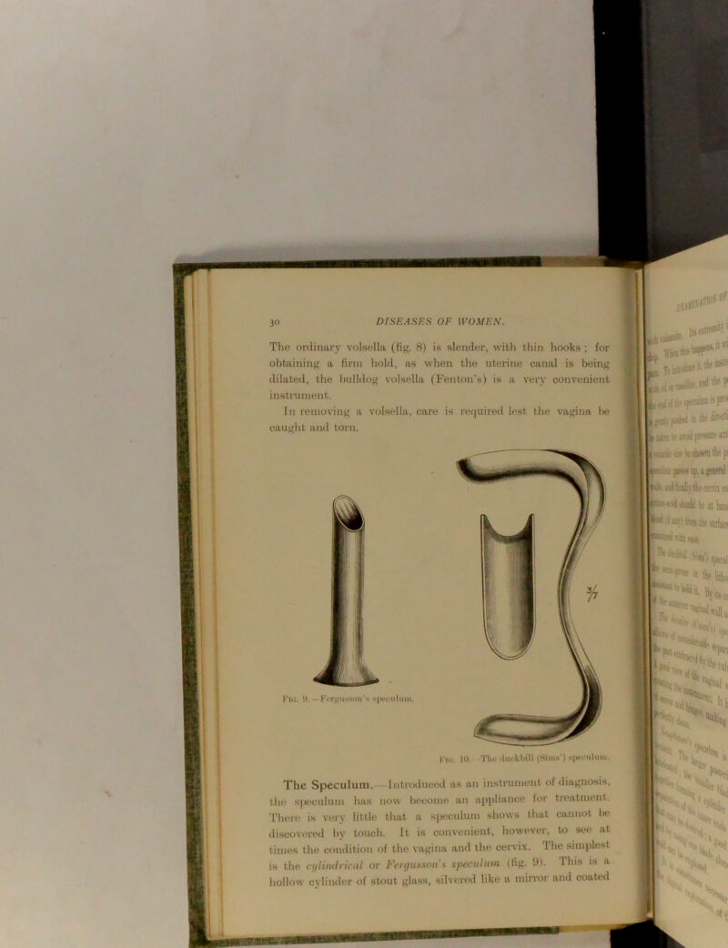 Tlie ordinary volsella (fig. 8) is slender, with thin hooks ; for obtaining a firm hold, as when the uterine canal is being dilated, the bulldog volsella (Fenton’s) is a very convenient instmiuent. In removing a volsella, care is required lest the vagina l)e caught and torn. jemir piisW ai-j to jvii ffKS® ^ins pKS6 up, i euml toil', and fc’illyfc cervix CO ^■loolvboBlil be it kill Kio. a. — KiTtni-ssiiir-i spwnlum.