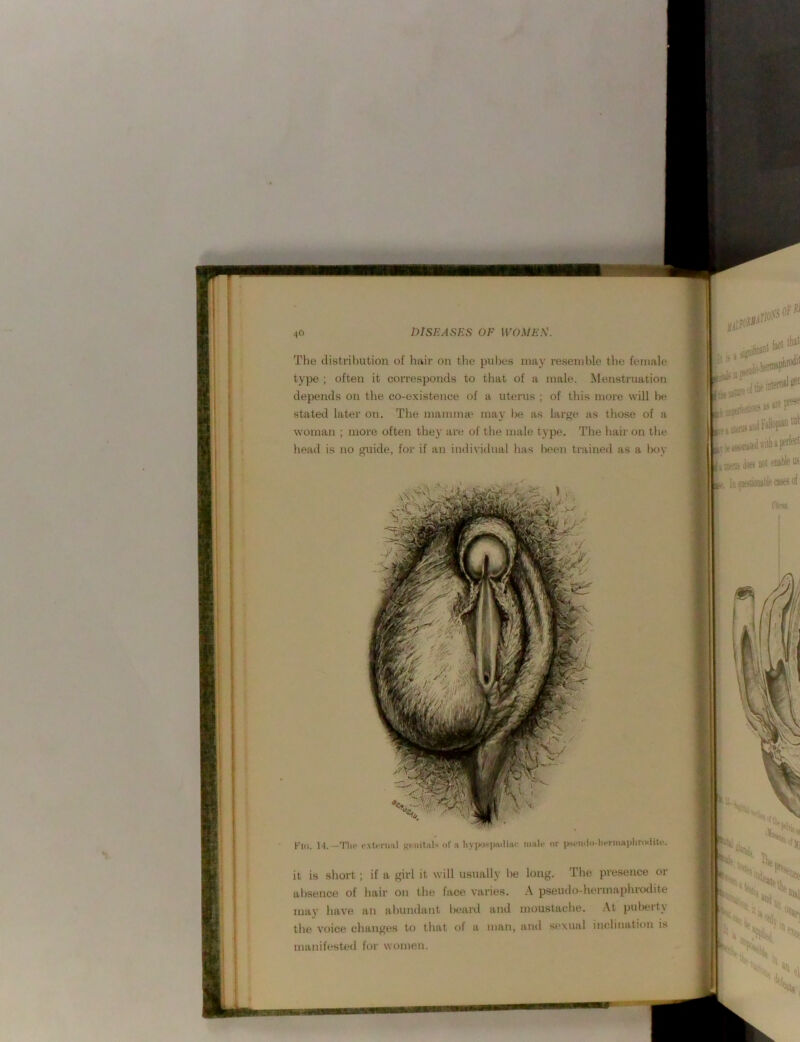 The distrihution of hair on tlie pubes may resemble tlie female type ; often it con-esponds to that of a niale. Menstruation depends on the co-existence of a uterus ; of this more will be stated later on. The mamime may l>e as large as those of a womati ; more often thej’ are of the male type. The hair on the head is no guide, for if an iiulividual lias been trained as a boy it is short ; if a girl it will usually be long. The presence or absence of hair on the face varies. \ pseudo-hermaphrodite may have an abundant beai’d and moustache. At puberty the voice changes to that of a man, and sexual inclination is manifested for women.