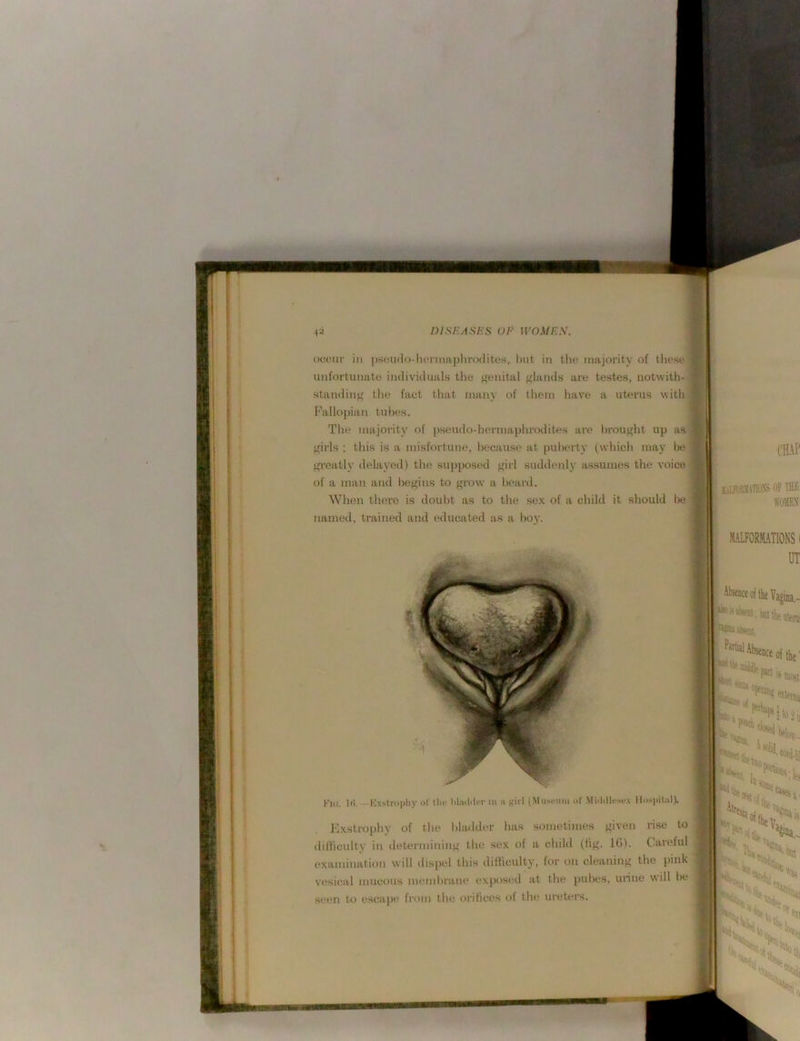 (jcciir in jjseudo-heiniaphrodites, l)ut in the majority of tliese unfortunate individuals the ‘jenital glands are testes, notwith- standing tlie fact tliat many of them have a uterus with Fallopian tul>es. The majority of pseudo-hermaphrodites are brought up as girls ; tliis is a misfortune, because at puberty (which may be gi'Gatly delayed) the supposed girl suddenly assumes the voice of a man and begins to grow' a beard. When thei’e is doubt as to the sex of a child it should 1x3 named, ti’ained and educated as a boy. DISEASES OF WOMEW CHAP lil^ijRUTlOXS OF THE WOMEN Klc. Iti.—Kx.stropliy of tlio tiliulcifr m h girl (Miiscnm of MiiMlcsex llospigil). Exstrophy of tlie Ifladder lias sometimes given rise to dilhculty in determining the sex of a child (Hg. 16). Careful examination will dispel this difficulty, for on cleaning the pink vesical mucous membrane exposed at tlie pubes, unne will be seen to escape from tlie orifices of the ureters.