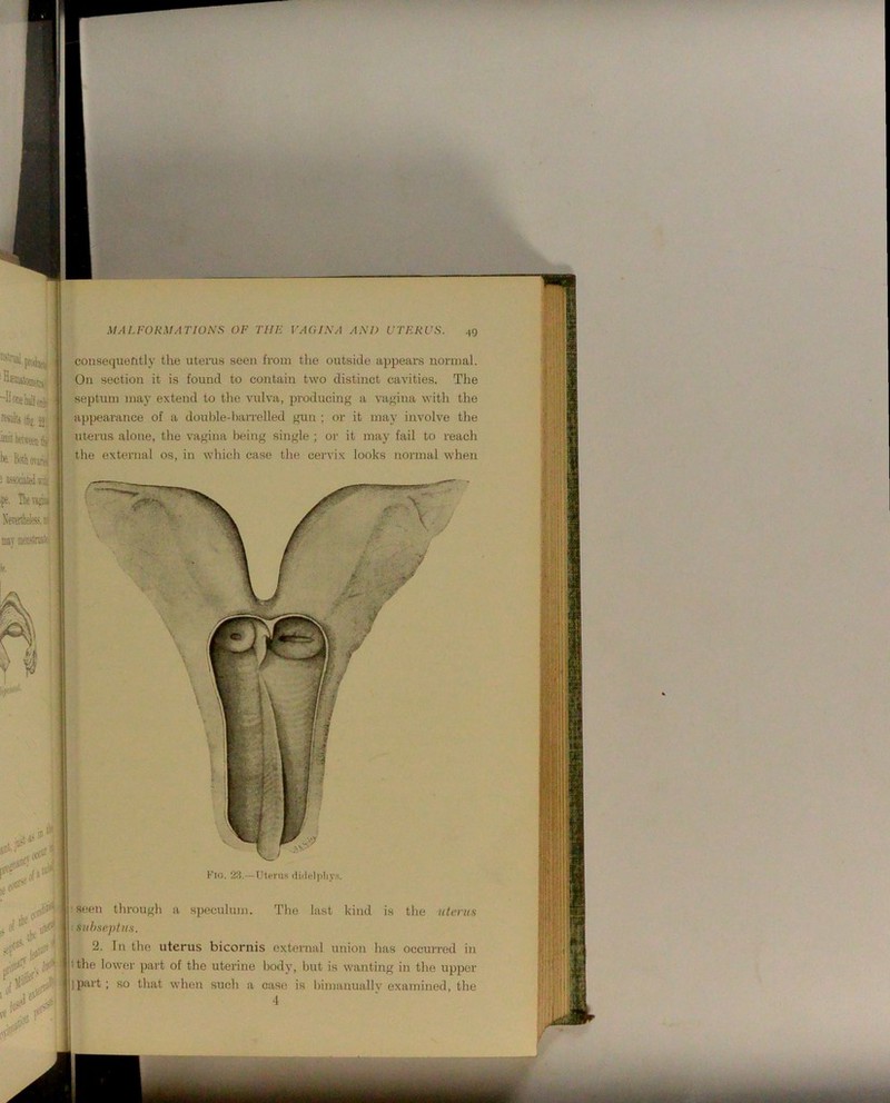 •19 ifij jfflit betstai )*• BoiliOTj.% ! aisoray , ipe. 'DieTi^ ; Nerathete-irf] MT meastnaiei ] consequently the utems seen from the outside appears normal. On section it is found to contain two distinct cavities. The septum may extend to the vulva, producing a vagina with the ajipearance of a double-1lairelled gun ; or it may involve the uterus alone, the vagina lieing single ; or it may fail to reach the external os, in which case the cervix looks normal when jdU’ st ■ ir iiity Kio. 2.3.—uterus dulelpliy.s. !seen through a speculum. The last kind is the ntenis \ jiithHephiH. tthe lower part of the uterine bodj% but is wanting in the upper I part ; so that when sucli a case is bimanuallv examined, the 4 ' I.