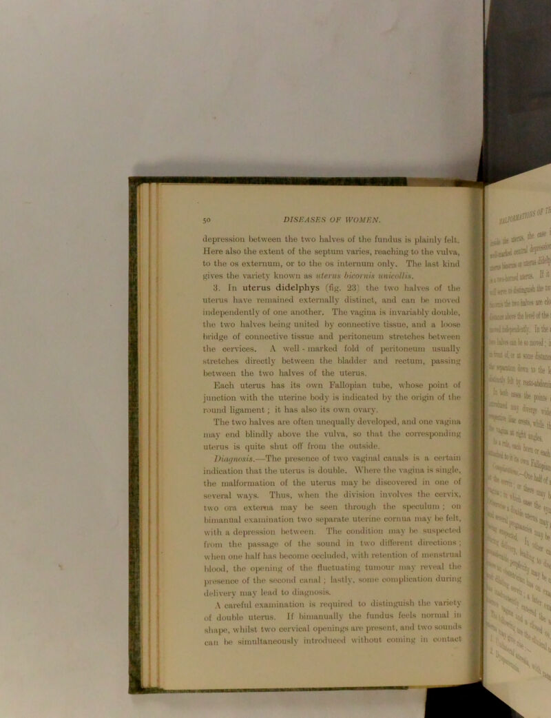Stvii 50 DISEASES OF WOMEN. depression between the two halves of the fundus is plainly felt. Here also the extent of the septum varies, reaching to the vulva, to the os externum, or to the os internum only. The last kind gives the variety known as uterus hic&niis vnicollis. 3. In uterus didelphys (fig. 23) the two halves of the uterus have remained externally distinct, and can l«* moved independently of one another. The vagina is invariably douljle, the two halves being united by connective tissue, and a loose lu’idge of connective tissue and peritoneum stretches between the cervices. A well - marked fold of peritoneum usually stretches directly between the bladder and rectum, passing between the two halves of the uterus. Each uterus has its own Fallopian tube, whose point of junction with the nterine body is indicated by the origin of the round ligament; it has also its own ovary. The two halves are often unequally developed, and one vagina may end blindly above the vulva, so that the corresponding uterus is quite shut olT from the outside. Diminosis.—The presence of two vaginal canals is a certain indication that the uterus is double. Where the vagina is single, the malformation of the uterus may be discovered in one of several ways. Thus, when the division involves the cervix, two ora exteiMia may l>e seen through the speculum ; on bimanual examination two separate uterine cornua may be felt, with a depression between. The condition may l>e susj>ected from the passagt? of the sound in two ilitferent directions ; when one half has become occluded, with retention of menstrual blood, the opening of the lluctuating tumour may reveal the prt!sence of the second canal ; lastly, some complication during deliv(!ry may lead to diagnosis. A careful examination is required to distinguish the variety of double uterus. If bimanually the fundus feels normal in shape, whilst two cervical openings are present, and two souiuls can be simultaneously intro<luced without coming in contact the ' sie eh) ;~r.^i!»vetbeMo(th61 In the ( klfr'can lie so moved; ii ct.or it 'em distancf *pwiioB down w the k ^ the points i tty forg, ?Ktve kt iwe [s w ( m *«tSt while th lol. i V-/ ’‘fill,' '“^1, ^ , Ak ''fise- '?{»1