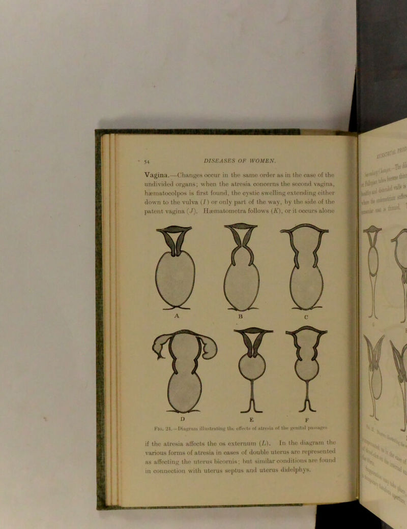 ' IK&W. •.4, DISEASES OF WOMEN. Vagina.—Chaiiifes occur in the same order as in the case of the undivided orffans; when the atresia concerns the second vagina, hamiatocolpos is first found, the cystic swelling extending either down to the vulva {/) or only i>art of the way, hy the side of the patent vagina (-/). flienuitometra follows (A'), or it occurs alone D E ‘ F Klii. 21.—Di.ifiraiii illuslniliiig tlii. i-HVi'ts or iitrvsia ot llic gfitilul j>i»ssuni-s if the atresia afl'ects the os externum (lA. In the diagram the various forms of atresia in cases of double uterus are represented as affecting the uterus bieornis; but similar conditions arc* fouiul in connection with uterus septus and uterus didelphys.