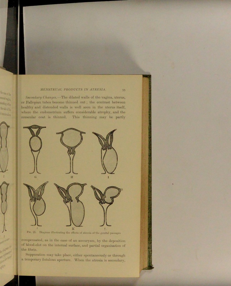 Secondanj Chantjes.—The dilated walls of the vagina, uterus, or Fallopian tubes l)ecome thinned out ; the contrast between healthy and distended walls is well seen in the uterus itself, where the endoinetriuin suffers considerable atrophy, and the muscular coat is thinned. This thinning may he partly I Kic. 2.5. Diii^'raiii illustnitiiig tliu elt'fcts of lUn'.siii of tlio gi-iiit.al jm.ss.igc.s compensated, as in the case of an aneurysm, Ijy the deposition of l)lood-clot on the internal surface, and partial organisation of the tihrin. Suppuration may take jdaci;, either sj)ontaneously or through a temporary fistulous aperture. When the atresia is secondary,