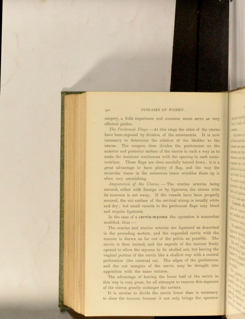 surgery, a little experience and common sense sei’ve as very efficient guides. The Peritoneal Flaps.—At this stage the sides of the uteinis have been exposed by division of the mesometria. It is now necessary to determine the relation of the bladder to the uterus. The surgeon then divides the peritoneum on the anterior and postei'ior surface of the uterus in such a way as to make the incisions continuous with the opening in each meso- metrium. These flaps are then carefully turned down; it is a great advantage to have plenty of flap, and the way the muscular tissue in the subserous tissue wrinkles them up is often very astonishing. Amputation of the Uterus. — The uterine arteries being secured, either with forceps or by ligatures, the uterus with its tumours is cut away. If the vessels have been properly secured, the cut surface of the cervical stump is usually white and dry ; but small vessels in the peritoneal flaps may bleed and require ligatures. In the case of a cervix-myoma the operation is somewhat modified, thus :— The ovarian and uterine arteries are ligatured as described in the preceding section, and the expanded cervix with the tumour is drawn as far out of the pelvis as possible. The cervix is then incised, and the capsule of the tumour freely opened to allow the myoma to be shelled out, but leaving the vaginal portion of the cervix like a shallow cup with a central perforation (the external os). The edges of the peritoneum and the cut margins of the cervix may be brought into apposition with the same sutures. The advantage of leaving the lower half of the cervix in this way is very great, for all attempts to remove this segment of the uterus greatly endanger the ureters. It is unwise to divide the cervix lower than is necessary to clear the tumour, because it not only brings the operator hii kt It jRierc. Mjiuiwti ^ ollilooiludtlie isssek are prop [:• arws are then tOiMii over the toffitlier by a tl P^tdeofoDead Bi ®re ffluj; 1)0 yj i^^pelrisisspcw I;' iiitesiinH 1^1 ij I ■vf'l usual Coiapiete 1 and sf instmiH, Hy ^. f ' !? ^iis ¥