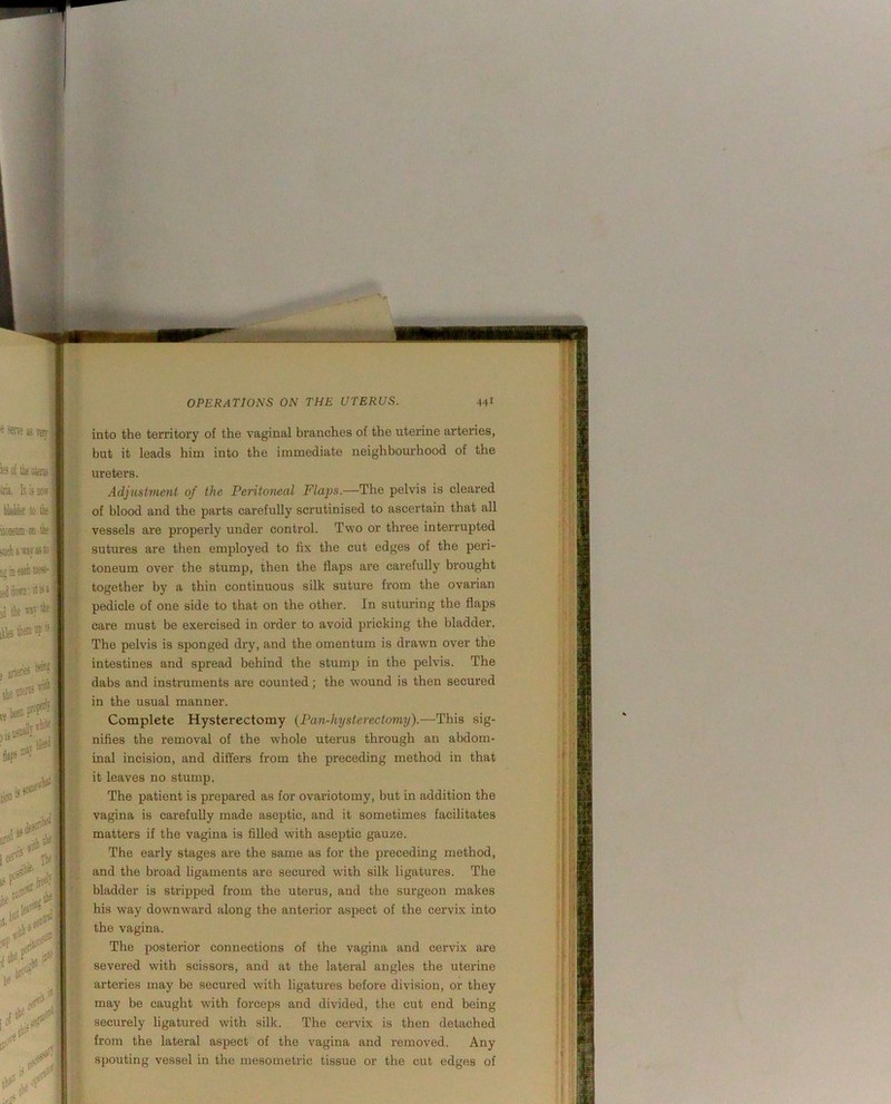 into the territory of the vaginal branches of the uterine arteries, but it leads him into the immediate neighboui’hood of the ureters. Adjustment of the Peritojieal Flaps.—The pelvis is cleared of blood and the parts carefully scrutinised to ascertain that all vessels are properly under control. Two or three interrupted sutures are then employed to fix the cut edges of the peri- toneum over the stump, then the flaps are carefully brought together by a thin continuous silk suture from the ovarian pedicle of one side to that on the other. In suturing the flaps care must be exercised in order to avoid pricking the bladder. The pelvis is sponged dry, and the omentum is drawm over the intestines and spread behind the stump in the pelvis. The dabs and instruments are counted; the wound is then secured in the usual manner. Complete Hysterectomy {Pan-hysterectomy).—This sig- nifies the removal of the whole uterus through an abdom- inal incision, and differs from the preceding method in that it leaves no stump. The patient is prepared as for ovariotomy, but in addition the vagina is carefully made aseptic, and it sometimes facilitates matters if the vagina is filled with aseptic gauze. The early stages are the same as for the preceding method, and the broad ligaments are secured with silk ligatures. The bladder is stripped from the uterus, and the surgeon makes his way downward along the anterior aspect of the cervix into the vagina. The posterior connections of the vagina and cervix are severed wdth scissors, and at the lateral angles the uterine arteries may be secured with ligatures before division, or they may be caught with forceps and divided, the cut end being securely ligatured with silk. The cervix is then detached from the lateral aspect of the vagina and removed. Any spouting vessel in the mesometrie tissue or the cut edges of