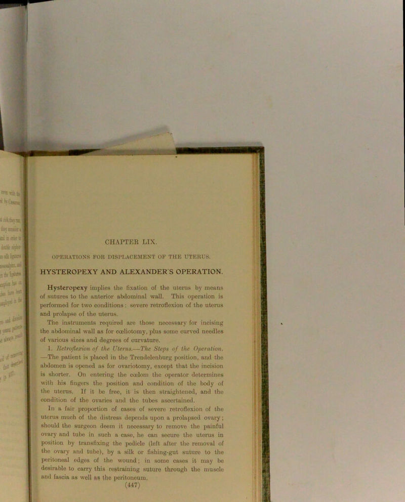 HYSTEROPEXY AND ALEXANDER S OPERATION, Hysteropexy implies the fixation of the uterus by means of sutures to the anterior abdominal wall. This operation is performed for two conditions: severe retroflexion of the uterus and prolapse of the uterus. The instruments requii-ed are those necessary for incising the abdominal wall as for cceliotomy, plus some curved needles of various sizes and degrees of curvature. 1. Retroflexion of the Uterus.—The Steps of the Operation. —The patient is placed in the Trendelenburg position, and the abdomen is opened as for ovariotomy, except that the incision is shorter. On entering the coelom the operator determines with his fingers the position and condition of the body of the uterus. If it be free, it is then straightened, and the condition of the ovaries and the tubes ascertained. In a fair proportion of cases of severe retroflexion of the uterus much of the distress depends upon a prolapsed ovary; should the surgeon deem it necessary to remove the painful ovary and tube in such a case, he can secure the uterus in position by transfixing the pedicle (left after the removal of the ovary and tube), by a silk or fishing-gut suture to the peritoneal edges of the wound; in some cases it may be desirable to carry this restraining suture through the muscle and fascia as well as the peritoneum,