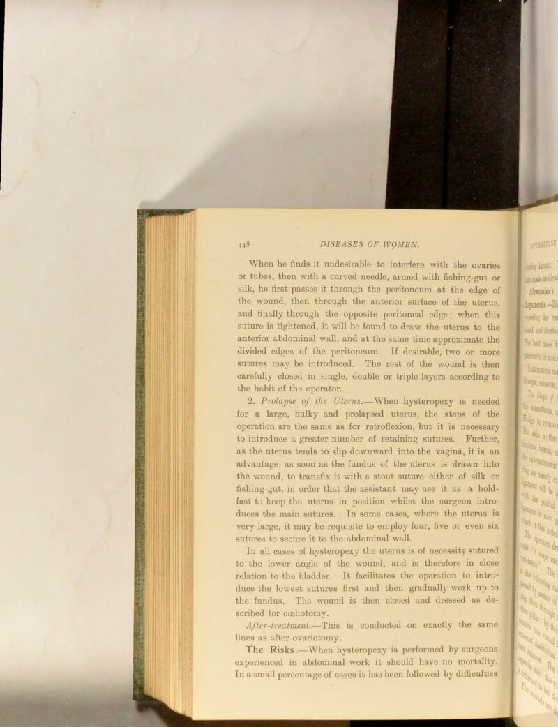 When he finds it undesirable to interfere with the ovaries or tubes, then with a curved needle, armed with fishing-gut or silk, he first passes it through the peritoneum at the edge of the w'ound, then through the anterior surface of the uterus, and finally through the opposite peritoneal edge; when this suture is tightened, it will be found to draw the uterus to the anterior abdominal wall, and at the same time approximate the divided edges of the peritoneum. If desirable, two or more sutures may be introduced. The rest of the wound is then carefully closed in single, double or triple layers according to the habit of the operator. 2. Prolapse of the Uterus.—When hysteropexy is needed for a large, bulky and prolapsed uterus, the steps of the operation are the same as for retroflexion, but it is necessary to introduce a greater number of retaining sutures. Further, as the uterus tends to slip downward into the vagina, it is an advantage, as soon as the fundus of the uterus is drawn into the wound, to transfix it with a stout suture either of silk or fishing-gut, in order that the assistant may use it as a hold- fast to keep the uterus in position whilst the surgeon intro- duces the main sutures. In some cases, where the uterus is very large, it may be requisite to employ four, five or even six sutures to secure it to the abdominal wall. In all cases of hysteropexy the uterus is of necessity sutured to the lower angle of the wound, and is therefore in close relation to the bladder. It facilitates the operation to intro- duce the lowest sutures first and then gradually work up to the fundus. The wound is then closed and dressed as de- scribed for coeliotomy. ifter-trcatment.—This is conducted on exactly the same lines as after ovariotomy. The Risks.—When hysteropexy is performed by surgeons experienced in abdominal work it should have no mortality. In a small percentage of casee it has been followed by difliculties .llmnder's Lijaments-Iiii t apomg fe ron analtnilsIiKten liest OSes fo wffiiaitisiinco] Ittitramcntst ffintsreq ®*ps:sffisois;i ^ Of I, Kie S, KK k. \