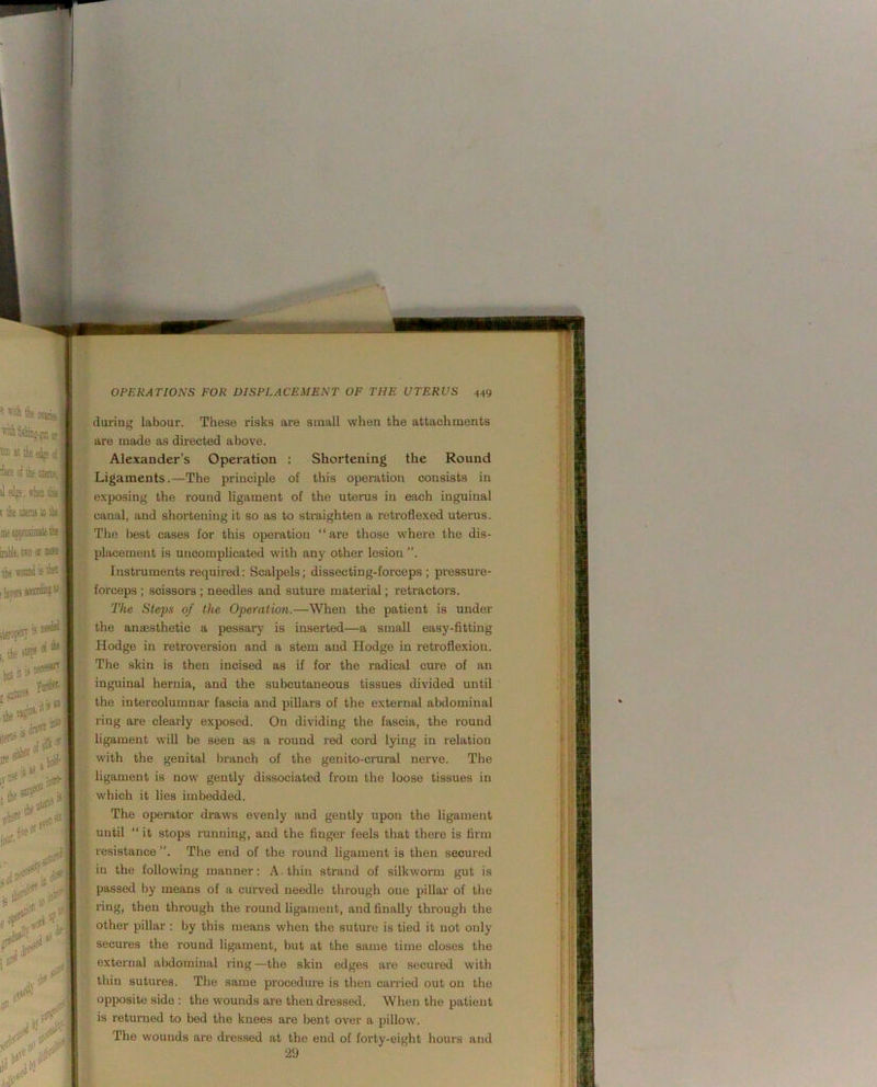 6 with the OTjife^ j hshiiig-gnt or I ffiD it the ed^ d: o! the ntetcv tledge;wheaihB. rihe steitis to the meapsiiiistel inhle, tiro or aic the *oand is li ilaveissaotii®?’'’ ,the5BF5’ it 15 seoe^ty I#.*” op 11*1 during labour. These risks are small when the attachments are made as directed above. Alexander’s Operation : Shortening the Round Ligaments.—The principle of this operation consists in e.xposing the round ligament of the utenis in each inguinal canal, and shortening it so as to straighten a retroflexed uterus. The best cases for this operation “are those where the dis- placement is uncomplicated with any other lesion ”. Instruments required: Scalpels; dissecting-forceps ; pressure- forceps ; scissors ; needles and suture material; retractors. The Steps of the Operation.—When the patient is under the anassthetic a pessary is inserted—a small easy-fitting Hodge in retroversion and a stem and Hodge in retroflexion. The skin is then incised as if for the radical cure of an inguinal hernia, and the subcutaneous tissues divided until the intercolumnar fascia and piUars of the external abdominal ring are clearly exposed. On dividing the fascia, the round ligament will be seen as a round red cord lying in relation with the genital branch of the genito-ci’ural nerve. The ligament is now gently dissociated from the loose tissues in which it lies imbedded. The operator draws evenly and gently upon the ligament until “ it stops running, and the finger feels that there is firm resistance The end of the round ligament is then secured in the following manner: A. thin strand of silkworm gut is passed by means of a cmwed needle through one pillar of the ring, then through the round ligament, and finally through the other pillar : by this means when the suture is tied it not only secures the round ligament, but at the same time closes the external abdominal ring—the skin edges are secured with thin sutures. The same procedure is then can’ied out on the opposite side : the wounds are then dressed. When the patient is returned to bed the knees are bent over a pillow. The wounds are dressed at the end of forty-eight hours and 29