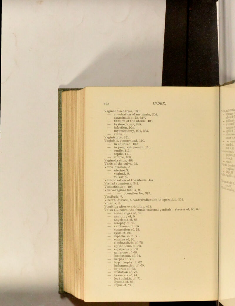 Vaginal discharges, lOG. — enucleation of myomata, 204. — examination. 23, 347. — fixation of the uterus, 403. — hysterectomy, 395. — infection, 104. — myomectomy, 204, 385. — veins, 9. Vaginismus, 331. Vaginitis, gonorrhoeal, 110. — in children, 109. — in pregnant women, 110. — senile. 111. — septic. 111. — simple, 108. Vaginofixation, 403. Varix of the vulva, 63. Veins, ovarian, 9. — uterine, 9. — vaginal, 9. — vulvar, 9. Ventrofixation of the uterus, 447. Vesical sj-mptorr.s, 341. Vesicofixation, 403. Vesico-vaginal fistula, 96. — — operation for, 373. Vestibule, 7. Visceral disease, a contraindication to operation, 354. Volsella, 28. Vomiting after ovariotomy, 422. Vulva (L. vulva, the female external genitals), abscess of, 66, 69. — age-changes of, 62. — anatomy of, 5. — angeioma of, 83. — atrophy of, 74. — carcinoma of, 85. — congestion of, 73. — cy.sts of, 85. — diphtheria of, 71. — eczema of, 70. — elephantiasis of, 72. — epithelioma of, 83. — erysipelas of, 68. — gangrene of, 68. — hfGinatoma of, 64. — herpes of, 71. — hypertrophj' of, 62. — inflammation of, 65. — injuries of, 63. — irritation of, 72. — kraurosis of, 74. — leukoplakia of, 71. — lipoma of, 83. — lupus of, 71.