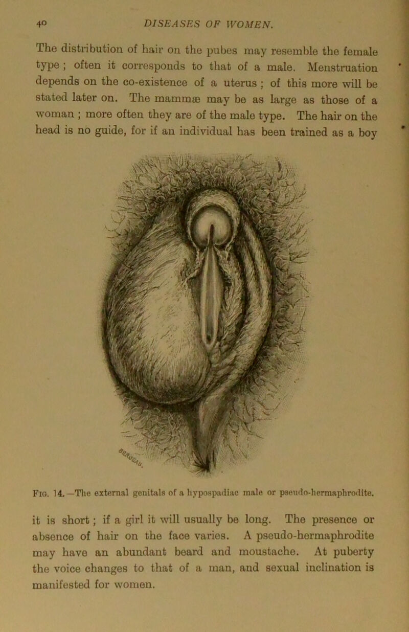 The distribution of hair on the pubes may resemble the female type; often it corresponds to that of a male. Menstruation depends on the co-existence of a uterus ; of this more will be stated later on. The mammae may be as large as those of a woman ; more often they are of the male type. The hair on the head is no guide, for if an individual has been trained as a boy Fio. 14. —Tlie external genitals of a liypospadiac male or psenilo-herraaphroilite. it is short; if a girl it will usually be long. The presence or absence of hair on the face varies. A pseudo-hermaphrodite may have an abundant board and moustache. At puberty the voice changes to that of a man, and sexual inclination is manifested for women.