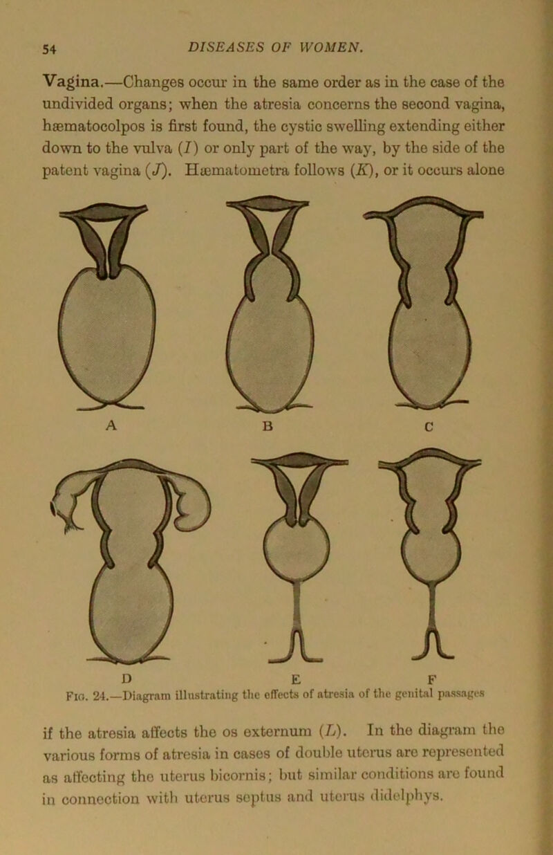 Vagina.—Changes occur in the same order as in the case of the undivided organs; when the atresia concerns the second vagina, hsematocolpos is first found, the cystic swelling extending either down to the vulva (I) or only part of the way, by the side of the patent vagina (c7). Hjematometra follows [E), or it occui’s alone D E F Fio. 24.—Diagram illustrating the effects of atresia of the genital passages if the atresia affects the os externum (L). In the diagram the various forms of atresia in cases of double uterus arc represented as affecting the uterus bicornis; but similar conditions arc found in connection with uterus septus and utcius didelphys.