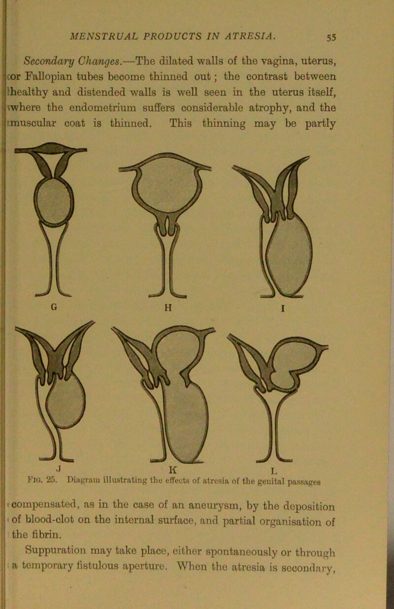 Secondary Changes.—The dilated walls of the vagina, uterus, cor Fallopian tubes become thinned out; the contrast between Ihealthy and distended walls is well seen in the uterus itself, ;where the endometrium suffers considerable atrophy, and the Fio. 25. Diagram illvustrating the efTeuts of atresia of the genital pa-ssages (compensated, as in the case of an aneurysm, by the deposition I of blood-clot on the internal surface, and partial organisation of the fibrin. Suppuration may take place, either spontaneously or through ’ a temporary fistulous aperture. When the atresia is secondary, i