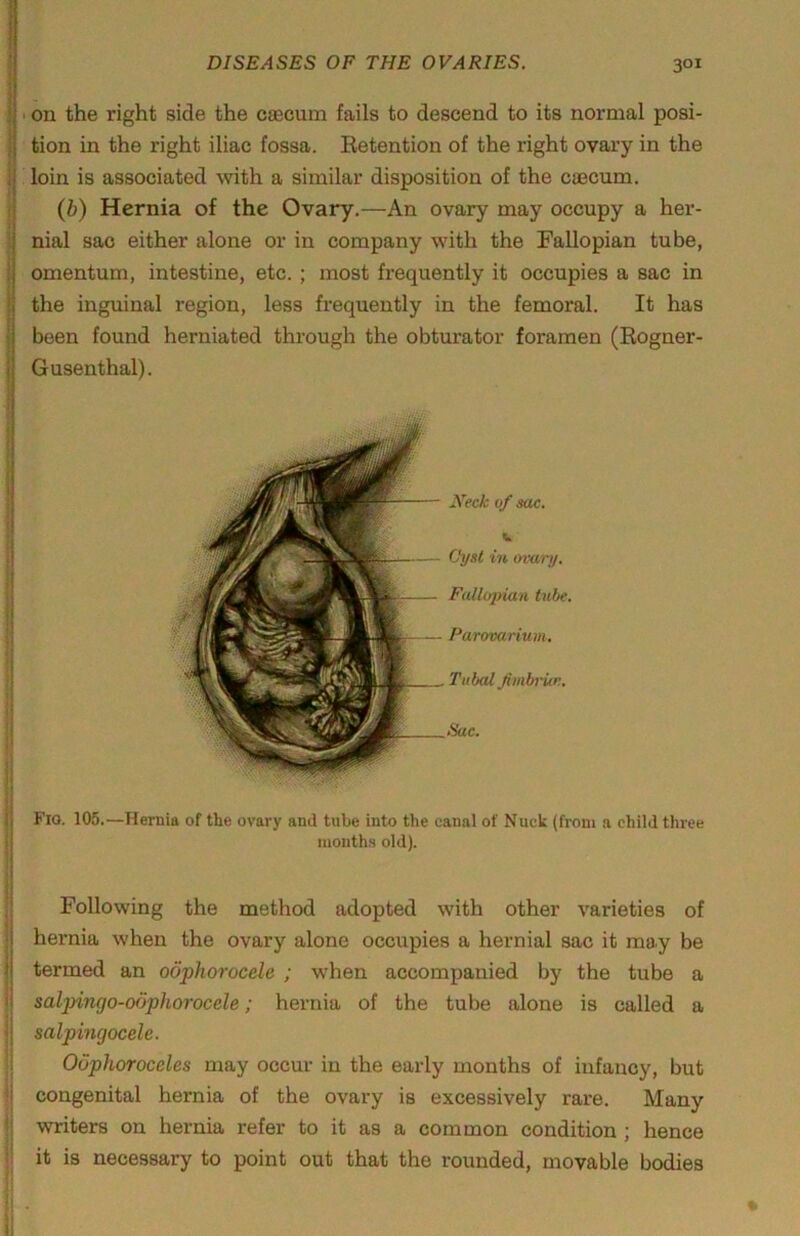 i ) 1 I • on the right side the caecum fails to descend to its normal posi- tion in the right iliac fossa. Retention of the right ovary in the loin is associated with a similar disposition of the caecum. (b) Hernia of the Ovary.—An ovary may occupy a her- nial sac either alone or in company with the Fallopian tube, omentum, intestine, etc.; most frequently it occupies a sac in the inguinal region, less frequently in the femoral. It has been found herniated through the obturator foramen (Rogner- Gusenthal). Xeck of sac. V Gysl in ovary. Fallopian tube. Parovarium. Tubal fimbi-Un. Sac. Fio. 106.—Hernia of the ovary and tube into the canal of Nuck (from a child three nioutha old). fl Following the method adopted with other varieties of ; hernia when the ovary alone occupies a hernial sac it may be I termed an oophorocele ; when accompanied by the tube a '■ salpirujo-obphorocele; hernia of the tube alone is called a salpingocele. Odphoroceles may occur in the early months of infancy, but congenital hernia of the ovary is excessively rare. Many writers on hernia refer to it as a common condition; hence it is necessary to point out that the rounded, movable bodies