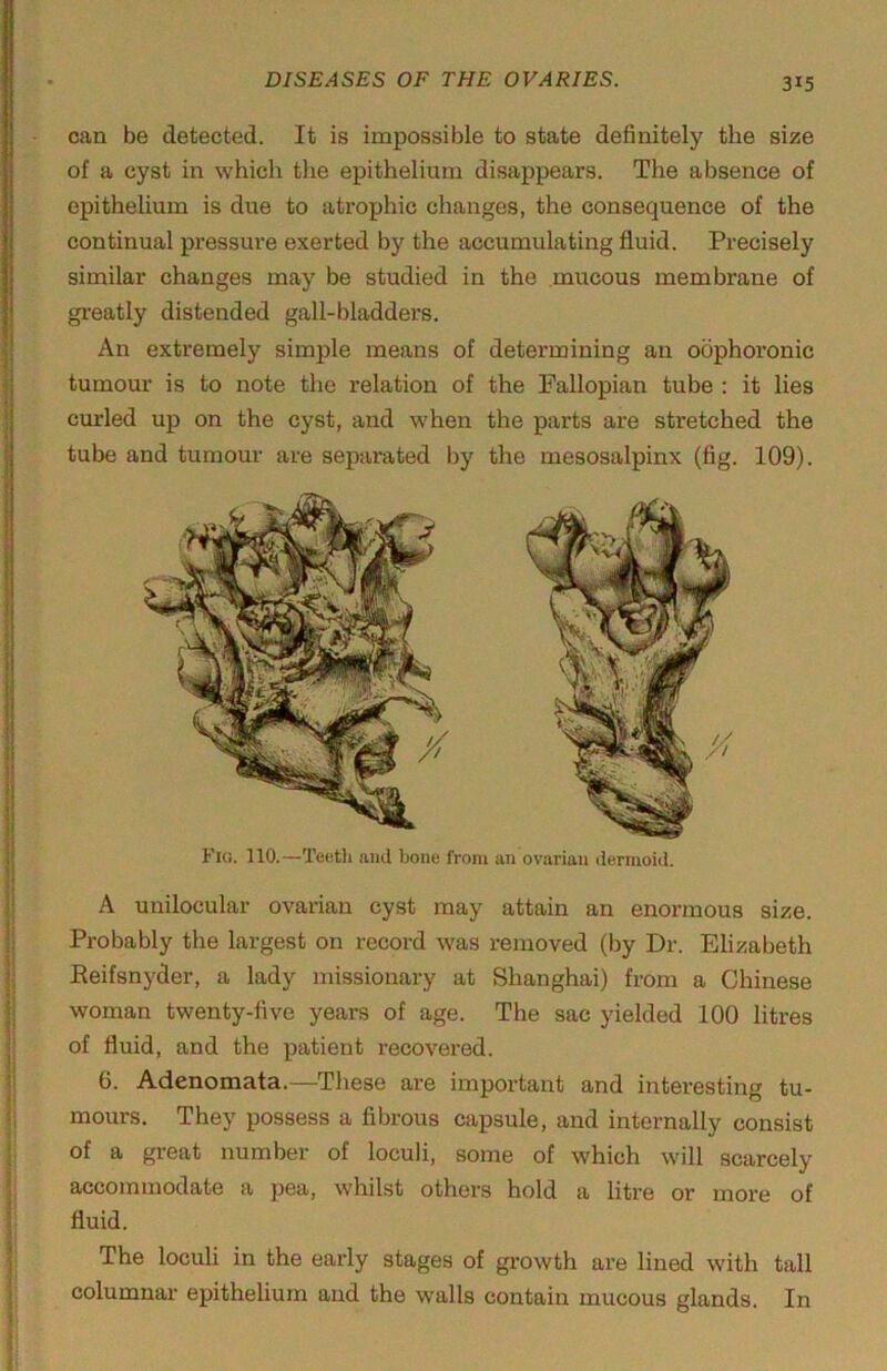 can be detected. It is impossible to state definitely the size of a cyst in which the epithelium disappears. The absence of epithelium is due to atrophic changes, the consequence of the continual pressure exerted by the accumulating fluid. Precisely similar changes may be studied in the mucous membrane of gi-eatly distended gall-bladders. An extremely simple means of determining an oophoi’onic tumour is to note the relation of the Fallopian tube : it lies curled up on the cyst, and when the parts are stretched the tube and tumour are separated by the mesosalpinx (fig. 109). Flo. 110.—Teeth and bone from an ovarian dermoid. A unilocular ovarian cyst may attain an enormous size. Probably the largest on record was removed (by Dr. Elizabeth Eeifsnyder, a lady missionary at Shanghai) from a Chinese woman twenty-five years of age. The sac yielded 100 litres of fluid, and the patient recovered. C. Adenomata.—These are important and interesting tu- mours. They possess a fibrous capsule, and internally consist of a great number of loculi, some of which will scarcely accommodate a pea, whilst others hold a litre or more of fluid. The loculi in the early stages of growth are lined with tall columnar epithelium and the walls contain mucous glands. In