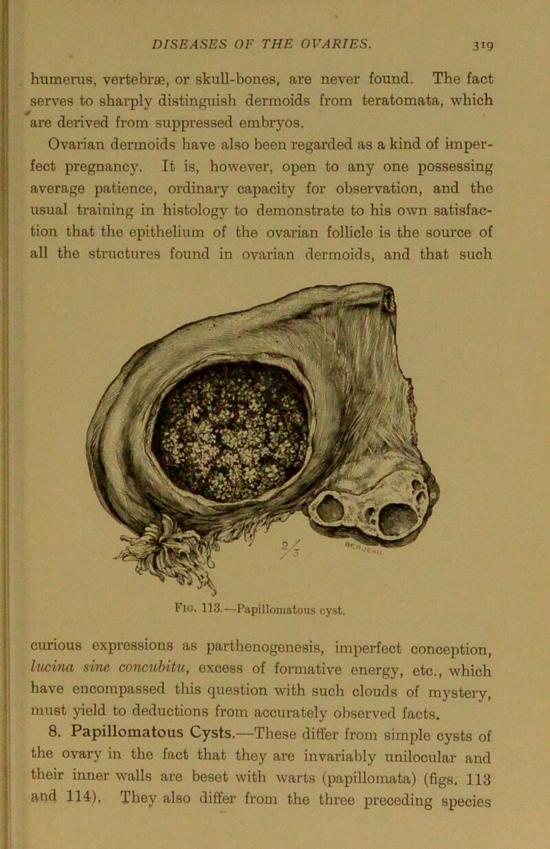 I ; humerus, vertebrae, or skull-bones, are never found. The fact serves to sharply distinguish dermoids from teratomata, which are derived from suppressed embryos. Ovarian dermoids have also been regarded as a kind of imper- fect pregnancy. It is, however, open to any one possessing average patience, ordinary capacity for observation, and the usual training in histology to demonstrate to his own satisfac- tion that the epithelium of the ovarian follicle is the source of all the structures found in ovarian dermoids, and that such Fio. 113.—Papillomatous cyst. curious expressions as parthenogenesis, imperfect conception, liiciiKi S'Vilc co7tG7ibit'Uj excess of formative energy, etc., which have encompassed this question with such clouds of mystery, must yield to deductions from accurately observed facts. 8. Papillomatous Cysts.—These differ from simple cysts of the ovary in the fact that they are invariably unilocular and their inner walls are beset with warts (papillomata) (figs. 113 and 114), They also differ from the three preceding species I