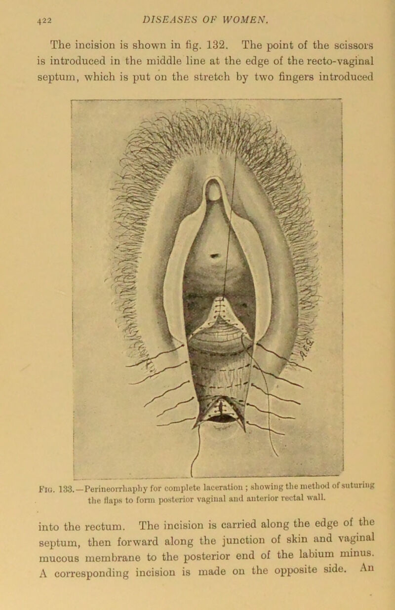 The incision is shown in fig. 132. The point of the scissois is introduced in the middle line at the edge of the recto-vaginal septum, which is put on the stretch by two fingers introduced Fio. 133.—Perineorrbapliy for complete laceration ; .showing the method of suturing the Haps to form posterior vaginal and anterior rectal wall. into the rectum. The incision is carried along the edge of the septum, then forward along the junction of skin and vaginal mucous membrane to the posterior end of the labium minus. A corresponding incision is made on the opposite side. An