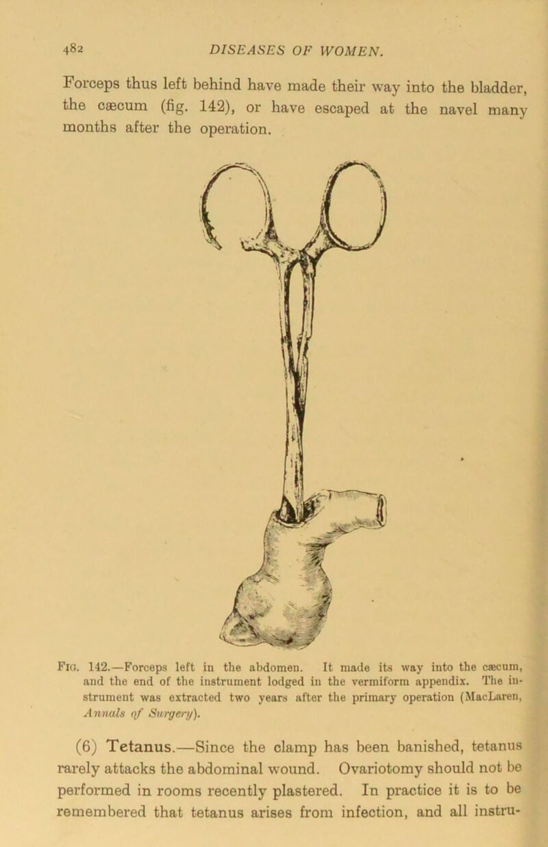 Forceps thus left behind have made their way into the bladder, the caecum (fig. 142), or have escaped at the navel many months after the operation. Fio. 142.—Forceps left in the abdomen. It made its way into the caecum, and the end of the instrument lodged in the vermiform appendix. The in- strument was extracted two years after the primary operation (MacLaren, Annuls of Surgery). (6) Tetanus.—Since the clamp has been banished, tetanus rarely attacks the abdominal wound. Ovariotomy should not be performed in rooms recently plastered. In practice it is to be remembered that tetanus arises from infection, and all instru-