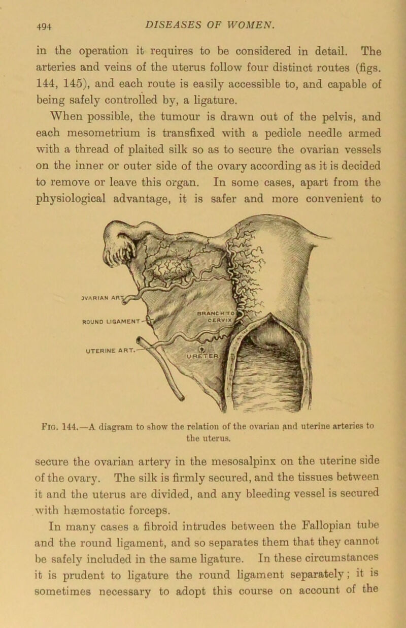 in the operation it requires to be considered in detail. The arteries and veins of the uterus follow four distinct routes (figs. 144, 145), and each route is easily accessible to, and capable of being safely controlled by, a ligature. When possible, the tumour is drawn out of the pelvis, and each mesometrium is transfixed with a pedicle needle armed with a thread of plaited silk so as to secure the ovarian vessels on the inner or outer side of the ovary according as it is decided to remove or leave this organ. In some cases, apart from the physiological advantage, it is safer and more convenient to Fio. 144.—A fliagratn to .show the relation of the ovarian and uterine arteries to the uterus. secure the ovarian artery in the mesosalpinx on the uterine side of the ovary. The silk is firmly secured, and the tissues between it and the uterus are divided, and any bleeding vessel is secured with luBinostatic forceps. In many cases a fibroid intrudes between the Fallopian tube and the round ligament, and so separates them that they cannot be safely included in the same ligature. In these circumstances it is prudent to ligature the round ligament separately; it is sometimes necessary to adopt this course on account of the