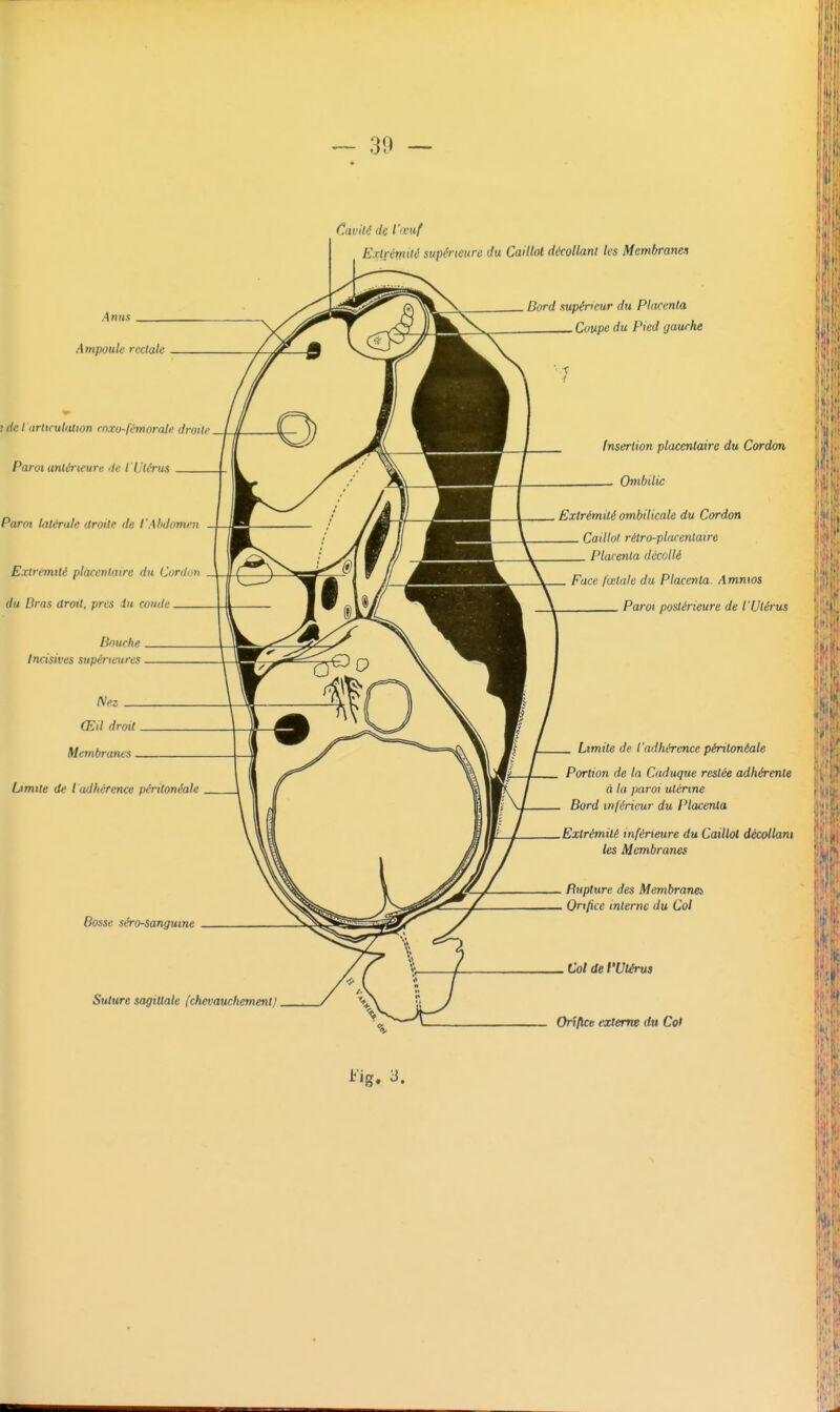 Anus Ampoule rectale dcl'iiritculiition cnxu-fémorcde. droite Paroi antérieure de l'Utérus Paroi latérale droite de l'Abdomen Extrémité placentaire du Cortlon du Dras aroit, prés iu coude Bouche Incisives supérieures Nez Œil droit Membranes Limite de l adhérence péritonéale Cavité de l'ivuf Extrémité supérieure du Caillot décollant les Membrane» Bord supérieur du Placenta Coupe du Pied gauche Bosse séro-sangume Suture sagittale [chevauchementJ Insertion placentaire du Cordon Ombilic Extrémité ombilicale du Cordon Caillol rétro-plnrentatre Placenta décollé Face fœtale du Placenta. Amnios Paroi postérieure de l'Utérus Limite de l'adhérence péritonéale Portion de la Caduque restée adhérente à la paroi utérine Bord inférieur du Placenta Extrémité inférieure du Caillot décollant les Membranes Rupture des Membranes Orifice interne du Col Col de l'Utérus Oft/lce externe du Co>