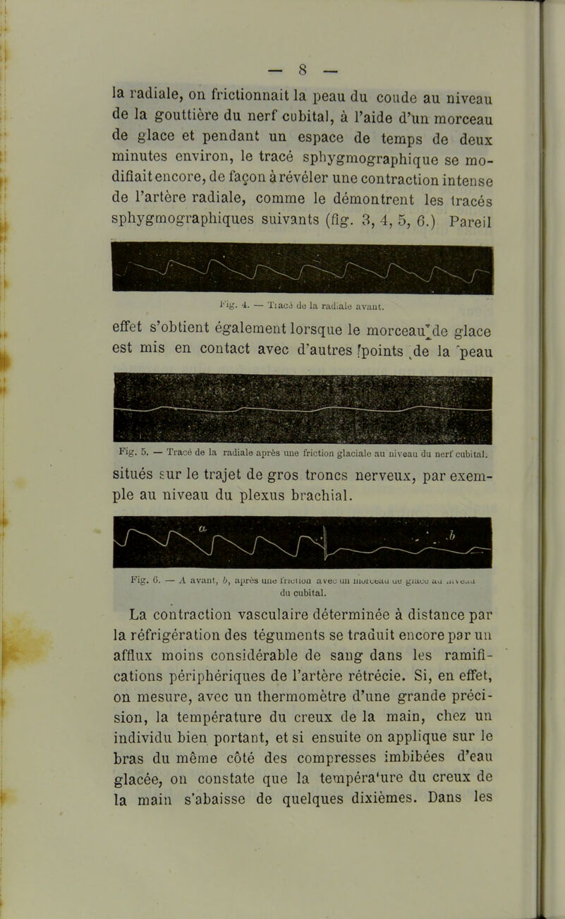 la radiale, on frictionnait la peau du coude au niveau de la gouttière du nerf cubital, à l'aide d'un morceau de glace et pendant un espace de temps de deux minutes environ, le tracé sphygmographique se mo- difiait encore, de façon à révéler une contraction intense de l'artère radiale, comme le démontrent les tracés sphygmographiques suivants (fig. 3, 4, 5, 6.) Pareil l'ig. 4. — Ttacé de la radiale avant. effet s'obtient également lorsque le morceauMe glace est mis en contact avec d'autres [points ,de la peau Fig. 5. — Tracé de la radiale après une friction glaciale au niveau du nerf cubital. situés sur le trajet de gros troncs nerveux, par exem- ple au niveau du plexus brachial. - * . J) ^ ^^^^ Fig. 0. — A avant, b, ajjrès une fnouou avec un luoiceau ue giaue au .mcau du cubital. La contraction vasculaire déterminée à distance par la réfrigération des téguments se traduit encore par un afflux moins considérable de sang dans les ramifi- cations périphériques de l'artère rétrécie. Si, en effet, on mesure, avec un thermomètre d'une grande préci- sion, la température du creux de la main, chez un individu bien portant, et si ensuite on applique sur le bras du même côté des compresses imbibées d'eau glacée, on constate que la température du creux de la main s'abaisse de quelques dixièmes. Dans les