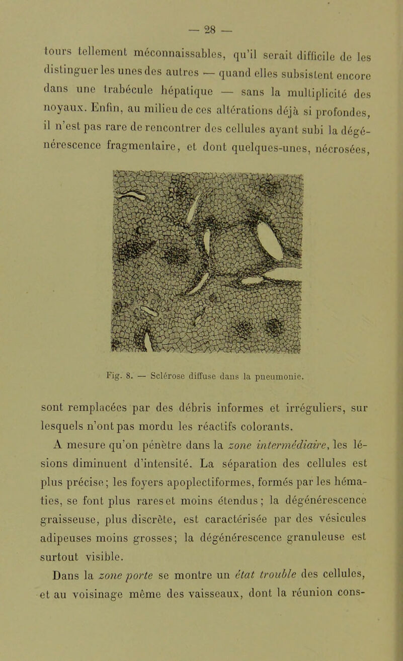 tours tellement méconnaissables, qu’il serait difficile de les distinguer les unes des autres — quand elles subsistent encore dans une trabécule hépatique — sans la multiplicité des noyaux. Enfin, au milieu de ces altérations déjà si profondes, il n’est pas rare de rencontrer des cellules ayant subi la dégé- nérescence fragmentaire, et dont quelques-unes, nécrosées, Fig. S. — Sclérose diffuse daus la pneumonie. sont remplacées par des débris informes et irréguliers, sur lesquels n’ont pas mordu les réactifs colorants. A mesure qu’on pénètre dans la zone intermédiaire, les lé- sions diminuent d’intensité. La séparation des cellules est plus précise; les foyers apoplcctiformcs, formés par les héma- ties, se font plus rares et moins éLendus ; la dégénérescence graisseuse, plus discrète, est caractérisée par des vésicules adipeuses moins grosses; la dégénérescence granuleuse est surtout visible. Dans la zone porte se montre un état trouble des cellules, et au voisinage même des vaisseaux, dont la réunion cons-