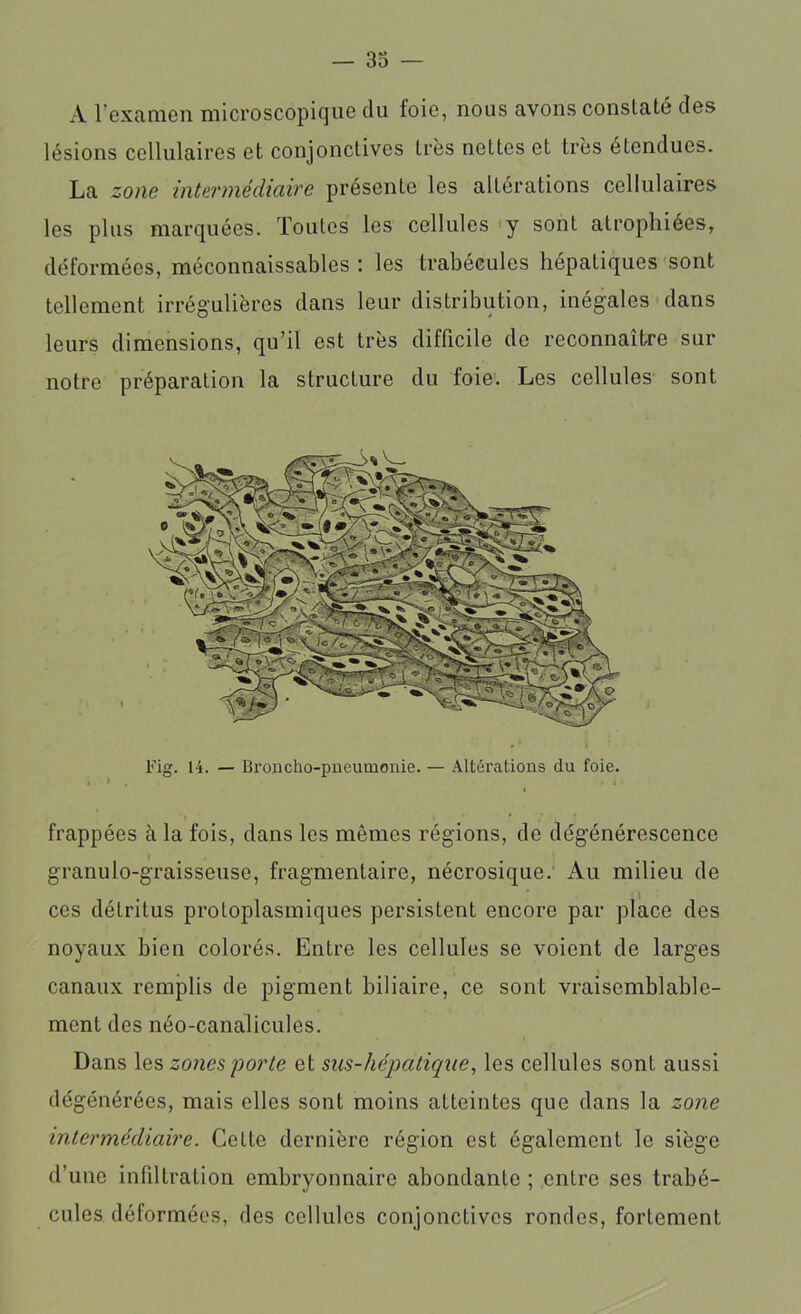 A 1 examen microscopique du foie, nous avons constaté des lésions cellulaires et conjonctives très nettes et très étendues. La zone intermédiaire présente les altérations cellulaires les plus marquées. Toutes les cellules y sont atrophiées, déformées, méconnaissables : les trabécules hépatiques sont tellement irrégulières dans leur distribution, inégales dans leurs dimensions, qu’il est très difficile de reconnaître sur notre préparation la structure du foie. Les cellules sont Fig. 14. — Broncho-pneumonie. — Altérations du foie. frappées à la fois, dans les mêmes régions, de dégénérescence granulo-graisseuse, fragmentaire, nécrosique. Au milieu de ces détritus protoplasmiques persistent encore par place des noyaux bien colorés. Entre les cellules se voient de larges canaux remplis de pigment biliaire, ce sont vraisemblable- ment des néo-canalicules. Dans les zones porte et sus-hépatique, les cellules sont aussi dégénérées, mais elles sont moins atteintes que dans la zone intermédiaire. Cette dernière région est également le siège d’une infiltration embryonnaire abondante ; entre ses trabé- cules déformées, des cellules conjonctives rondes, fortement