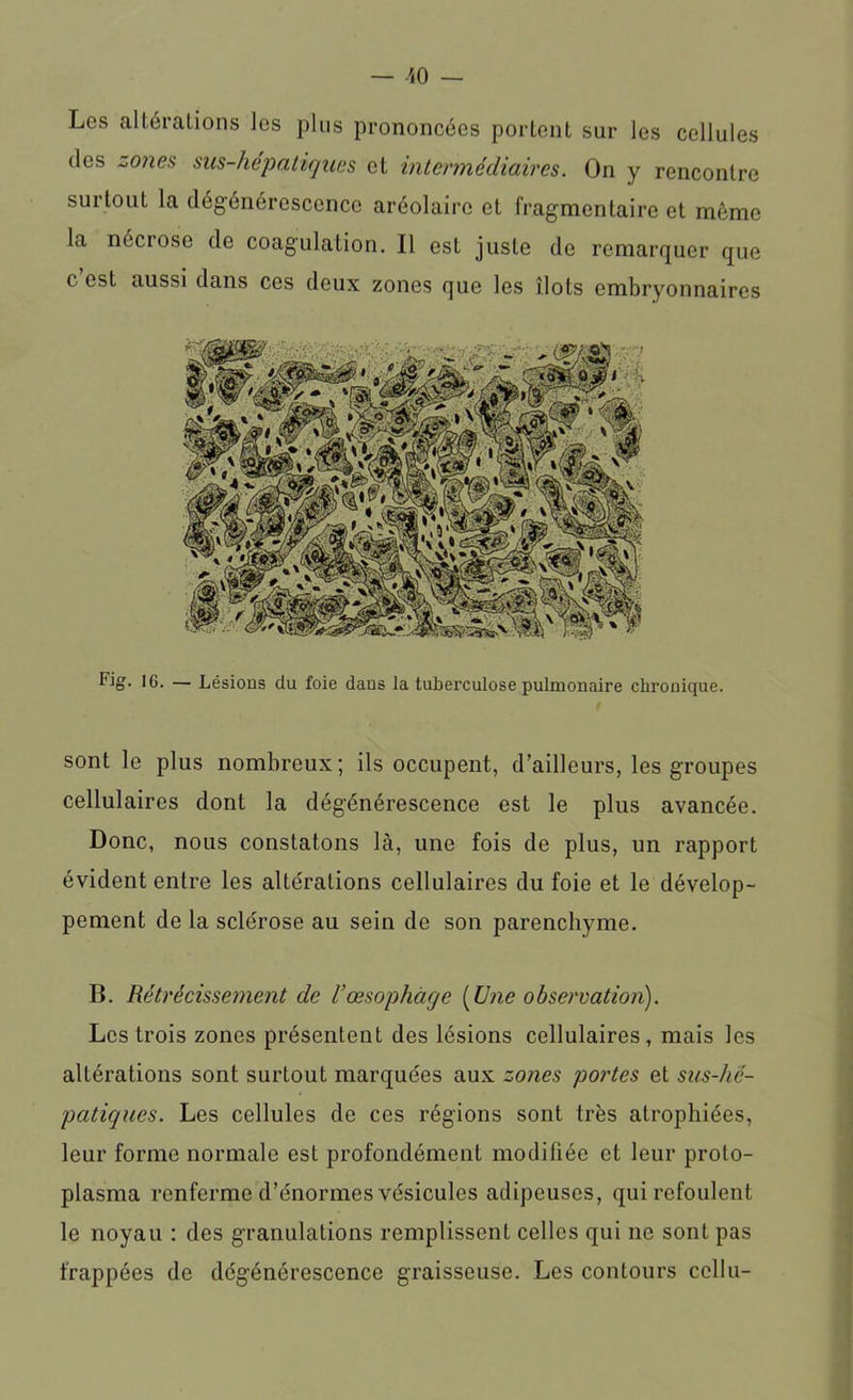 Les altérations les plus prononcées portent sur les cellules des zones sus-hépatiques et intermédiaires. On y rencontre sur tout la dégénérescence aréolairo et fragmentaire et même la nécrose de coagulation. Il est juste de remarquer que c est aussi dans cos deux zones que les îlots embryonnaires Fig. ig. — Lésions du foie dans la tuberculose pulmonaire chronique. sont le plus nombreux; ils occupent, d’ailleurs, les groupes cellulaires dont la dégénérescence est le plus avancée. Donc, nous constatons là, une fois de plus, un rapport évident entre les altérations cellulaires du foie et le dévelop- pement de la sclérose au sein de son parenchyme. B. Rétrécissement de l’œsophage (Une observation). Les trois zones présentent des lésions cellulaires, mais les altérations sont surtout marquées aux zones portes et sus-hé- patiques. Les cellules de ces régions sont très atrophiées, leur forme normale est profondément modifiée et leur proto- plasma renferme d’énormes vésicules adipeuses, qui refoulent le noyau : des granulations remplissent celles qui ne sont pas frappées de dégénérescence graisseuse. Les contours cellu-