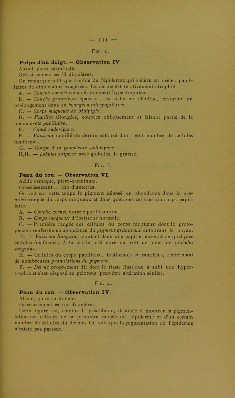 Fig. 2. Pulpe d’un doigt. — Observation IV. Alcool, picro-carminate. Grossissement = 33 diamètres. On remarquera l’hypertrophie de l’épiderme qui s’élève en crêtes papil- laires de dimensions exagérées. Le derme est relativement atrophié. A. — Couche cornée considérablement hypertrophiée. B. — Couche granuleuse épaisse, très riche en éléidine, envoyant un prolongement dans un bourgeon inter papillaire. C. — Corps muqueux de Malpighi. D. — Papilles allongées, coupées obliquement et faisant partie de la même crête papillaire. E. — Canal sudoripare. F. — Vaisseau ramifié du derme entouré d’un petit nombre de cellules fusiformes. G. — Coupe d’un glomérule sudoripare. H. H. — Lobules adipeux avec globules de graisse. Fig. 3. Peau du cou. — Observation VI. Acide osmique, picro-carminate. Grossissement = 220 diamètres. On voit sur cette coupe le pigment déposé en abondance dans la pre- mière rangée du corps muqueux et dans quelques cellules du corps papil- laire. A. — Couche cornée noircie par l’osmium. B. — Corps muqueux d’épaisseur normale. C. — Première rangée des cellules du corps muqueux dont le proto- plasma renferme en abondance du pigment granuleux entourant le noyau. D. — Vaisseau Sanguin, montant dans une papille, entouré de quelques cellules fusiformes. A la partie inférieure on voit un amas de globules sanguins. E. — Cellules du corps papillaire, fusiformes et ramifiées, renfermant de nombreuses granulations de pigment. F. — Derme proprement dit dont le tissu élastique a subi une hyper- trophie et s’est disposé en pelotons (peut-être altération sénile). Fig. 4. Peau du cou. — Observation IV. Alcool, picro-carminate. Grossissement = 400 diamètres. Cette figure est, comme la précédente, destinée à montrer la pigmen- tation des cellules de la première rangée de l’épiderme et d’un certain nombre de cellules du derme. On voit que la pigmentation de l’épiderme n’existe pas partout.