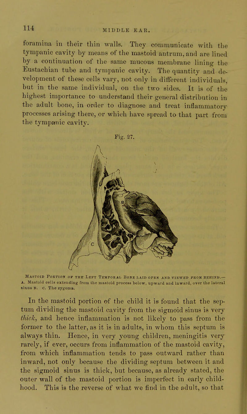 MIDDLE EAR. foramina in tlieir thin walls. They communicate with the tympanic cavity by means of the mastoid antrum, and are lined by a continuation of the same mucous membrane lining the Eustachian tube and tympanic cavity. The quantity and de- velopment of these cells vary, not only in different individuals, but in the same individual, on tlie two sides. It is of the highest importance to understand their general distribution in the adult bone, in order to diagnose and treat inflammatory processes arising there, or which have spread to that part from the tympanic cavity. Fig. 27. Mastoid Portiojt of the Left Temporal Bojte laid open and viewed from behind.— A. Mastoid cells extending from the mastoid process below, upward and inward, over the lateral sinus B. c. The zygoma. In the mastoid portion of the child it is found that the sep- tum dividing the mastoid cavity from the sigmoid sinus is very thick, and hence inflammation is not likely to pass from the former to the latter, as it is in adults, in whom this septum is always thin. Hence, in very young children, meningitis very rarely, if ever, occurs from inflammation of the mastoid cavity, from which inflammation tends to pass outward rather than inward, not only because the dividing septum between it and the sigmoid sinus is thick, but because, as already stated, the outer wall of the mastoid portion is imperfect in early child- hood. This is the reverse of what we And in the adult, so that