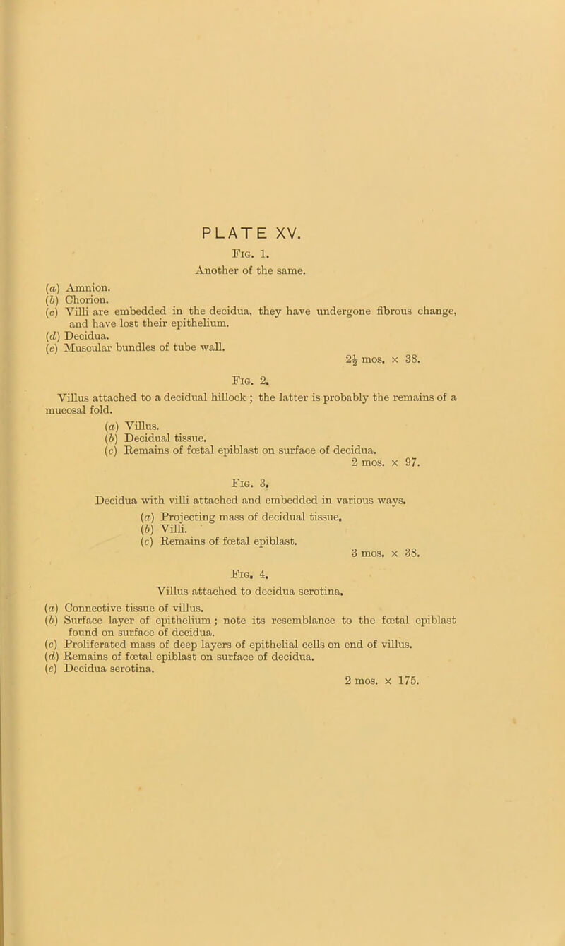 Fig. 1. Another of the same. (a) Amnion. (b) Chorion. (c) Villi are embedded in the decidua, they have undergone fibrous change, and have lost their epithelium. (d) Decidua. (e) Muscular bundles of tube wall. 2Jj mos. x 38. Fig. 2. Villus attached to a decidual hillock ; the latter is probably the remains of a mucosal fold. (a) Villus. (b) Decidual tissue. (c) Remains of foetal epiblast on surface of decidua. 2 mos. x 97. Fig. 3. Decidua with villi attached and embedded in various ways. (а) Projecting mass of decidual tissue, (б) Villi. (c) Remains of foetal epiblast. 3 mos. x 38. Fig. 4. Villus attached to decidua serotina. (a) Connective tissue of villus. (b) Surface layer of epithelium; note its resemblance to the foetal epiblast found on surface of decidua. (c) Proliferated mass of deep layers of epithelial cells on end of villus. (d) Remains of foetal epiblast on surface of decidua. (e) Decidua serotina.