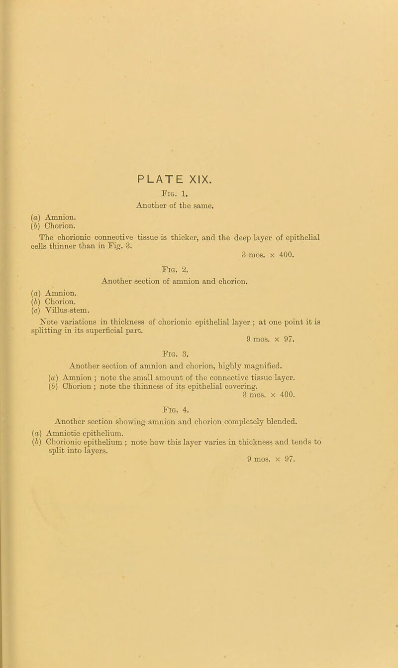 Fig. 1. Another of the same. (а) Amnion. (б) Chorion. The chorionic connective tissue is thicker, and the deep layer of epithelial cells thinner than in Fig. 3. 3 mos. x 400. Fig. 2. Another section of amnion and chorion. (a) Amnion. (b) Chorion. (c) Villus-stem. Note variations in thickness of chorionic epithelial layer ; at one point it is splitting in its superficial part. 9 mos. x 97. Fig. 3. Another section of amnion and chorion, highly magnified. (a) Amnion ; note the small amount of the connective tissue layer. (b) Chorion ; note the thinness of its epithelial covering. 3 mos. x 400. Fig. 4. Another section showing amnion and chorion completely blended. (a) Amniotic epithelium. (b) Chorionic epithelium ; note how this layer varies in thickness and tends to split into layers.