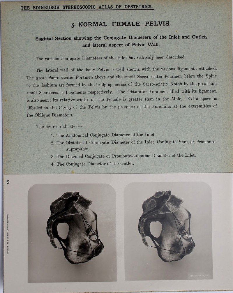 I - r- ^ ■. —** •— - ■ , • - THE EDINBURGH STEREOSCOPIC ATLAS OF OBSTETRICS. 5. NORMAL FEMALE PELVIS. Sagittal Section showing the Conjugate Diameters of the Inlet and Outlet, and lateral aspect of Pelvic Wall. The various Conjugate Diameters ol! the Inlet have already been described. The lateral wall of the bony Pelvis is well shown, with the various ligaments attached. The great Sacro-sciatic Foramen above and the small Sacro-sciatic Foramen below the Spine of the Ischium are formed by the bridging across of the Sacro-sciatic Notch by the great and small Sacro-sciatic Ligaments respectively. The Obturator Foramen, filled with its ligament, is also seen; its relative width in the Female is greater than in the Male. Extra space is afforded to the Cavity of the Pelvis by the presence of the Foramina at the extremities of the Oblique Diameters. The figures indicate :— 1. The Anatomical Conjugate Diameter of the Inlet. 2. The Obstetrical Conjugate Diameter of the Inlet, Conjugata Vera, or Promonto- suprapubic. 3. The Diagonal Conjugate or Promonto-subpubic Diameter of the Inlet.