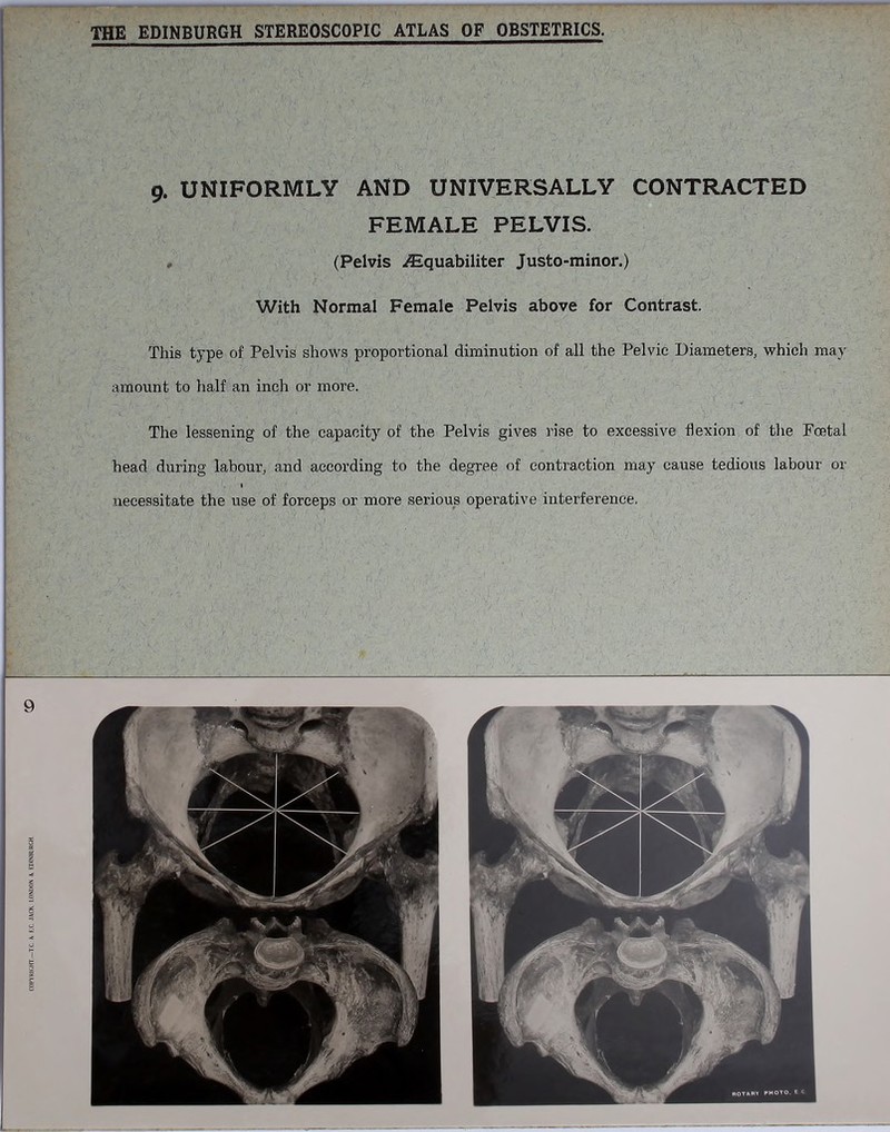 9. UNIFORMLY AND UNIVERSALLY CONTRACTED FEMALE PELVIS. (Pelvis iEquabiliter Justo-minor.) With Normal Female Pelvis above for Contrast. This type of Pelvis shows proportional diminution of all the Pelvic Diameters, which may amount to half an inch or more. The lessening of the capacity of the Pelvis gives rise to excessive flexion of the Foetal head during labour, and according to the degree of contraction may cause tedious labour or 1 necessitate the use of forceps or more serious operative interference.