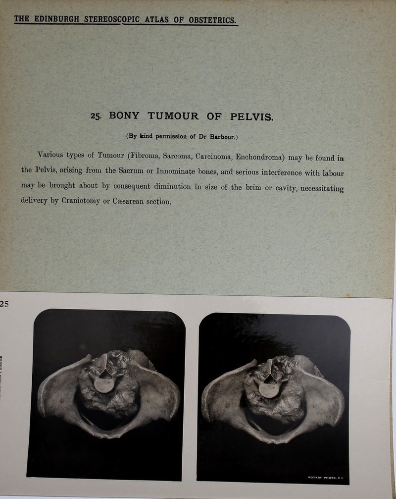 \ 25. BONY TUMOUR OF PELVIS. (By kind permission of Dr Barbour.) Various types of Tumour (Fibroma, Sarcoma, Carcinoma, Enchondroma) may be found in the Pelvis, arising from the Sacrum or Innominate bones, and serious interference with labour may be brought about by consequent diminution in size of the brim or cavity, necessitating delivery by Craniotomy or Caesarean section.