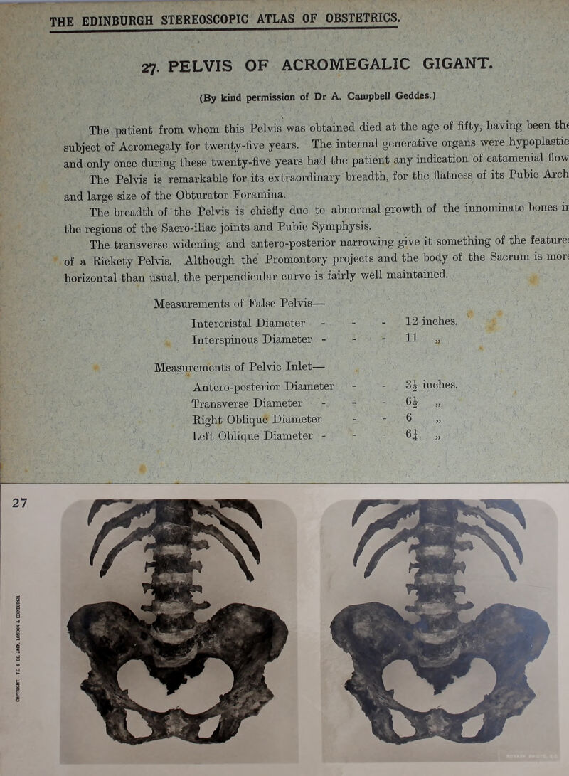 27. PELVIS OF ACROMEGALIC GIGANT. (By kind permission of Dr A. Campbell Geddes.) \ ) The patient from whom this Pelvis was obtained died at the age of fifty, having been the subject of Acromegaly for twenty-five years. The internal generative organs were hypoplastic and only once during these twenty-five years had the patient any indication of catamenial flow The Pelvis is remarkable for its extraordinary breadth, for the flatness of its Pubic Arch and large size of the Obturator Foramina. The breadth of the Pelvis is chiefly due to abnormal growth of the innominate bones ir the regions of the Sacro-iliac joints and Pubic Symphysis. The transverse widening and antero-posterior narrowing give it something of the feature! of a Rickety Pelvis. Although the Promontory projects and the body of the Sacrum is more horizontal than usual, the perpendicular curve is fairly well maintained. Measurements of False Pelvis— Intercristal Diameter - 12 inches. Interspinous Diameter - - 11 Measurements of Pelvic Inlet— Antero-posterior Diameter - 3| inches. Transverse Diameter - 6J Right Oblique Diameter - 6 Left Oblique Diameter - - 6| »