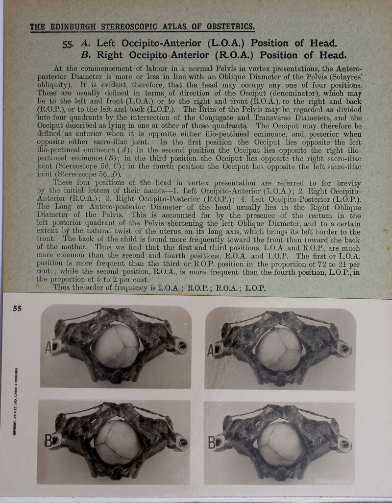 , ( . -■ ,-v , s THE EDINBURGH STEREOSCOPIC ATLAS OF OBSTETRICS. 55. A. Left Occipito-Anterior (L.O.A.) Position of Head. B. Right Occipito-Anterior (R.O.A.) Position of Head. 55 £ i 3 <3 2 At the commencement of labour in a normal Pelvis in vertex presentations, the Antero- posterior Diameter is more or less in line with an Oblique Diameter of the Pelvis (Solayres’ obliquity). It is evident, therefore, that the head may occupy any one of four positions. These are usually defined in terms. of direction of the Occiput (denominator), which may he to the left and front (L.O.A.), or to the right and front (E.O.A.), to the right and back (E.O.P.), or to the left and back (L.O.P.). The Brim of the Pelvis may be regarded as divided into four quadrants by the intersection of the Conjugate and Transverse Diameters, and the Occiput described as lying in one or other of these quadrants. The Occiput may therefore be defined as anterior when it is opposite either ilio-pectineal eminence, and posterior when opposite either sacro-iliac joint. In the first position the Occiput lies opposite' the left ilio-pectineal eminence (A); in the second position the Occiput lies opposite the right ilio- pectineal eminence (B); in the third position the Occiput lies opposite the right sacro-iliac joint (Stereoscope 58, C)\ in the fourth position the Occiput lies opposite the left sacro-iliac joint (Stereoscope 56, D). These four positions of the head in vertex presentation are referred to for brevity by the initial letters of their names—1. Left Occipito-Anterior (L.O.A.); 2. Eight Occipito- Anterior (E.O.A.); 3. Eight Occipito-Posterior (E.O.P.); 4. Left Occipito-Posterior (L.O.P.). The Long or Antero-posterior Diameter of the head usually lies in the Eight Oblique Diameter of the Pelvis. This is accounted for by the presence of the rectum in the left posterior quadrant of the Pelvis shortening the left Oblique Diameter, and to a certain extent by the natural twist of the uterus on its long axis, which brings its left border to the front. The back of the child is found more frequently toward the front than toward the back of the mother. Thus we find that the first and third positions, L.O.A. and E.O.P., are much more common than the second and fourth positions, E.O.A. and L.O.P. The first or L.O.A. position is more frequent than the third or E.O.P. position in the proportion of 72 to 21 per cent.; while the second position, E.O.A., is more frequent than the fourth position, L.O.P., in the proportion of 5 to 2 per cent. Thus the order of frequency is L.O.A.; E.O.P.; E.O.A.; L.O.P.