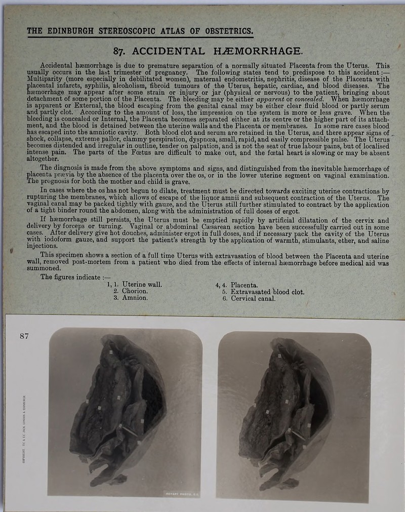 87. ACCIDENTAL HEMORRHAGE. Accidental haemorrhage is due to premature separation of a normally situated Placenta from the Uterus. This usually occurs in the last trimester of pregnancy. The following states tend to predispose to this accident:—- Multiparity (more especially in debilitated women), maternal endometritis, nephritis, disease of the Placenta with placental infarcts, syphilis, alcoholism, fibroid tumours of the Uterus, hepatic, cardiac, and blood diseases. The haemorrhage may appear after some strain or injury or jar (physical or nervous) to the patient, bringing about detachment of some portion of the Placenta. The bleeding may be either apparent or concealed. When haemorrhage is apparent or External, the blood escaping from the genital canal may be either clear fluid blood or partly serum and partly clot. According to the amount of loss, the impression on the system is more or less grave. When the bleeding is concealed or Internal, the Placenta becomes separated either at its centre or the higher part of its attach- ment, and the blood is detained between the uterine walls and the Placenta or membranes. In some rare cases blood has escaped into the amniotic cavity. Both blood clot and serum are retained in the Uterus, and there appear signs of shock, collapse, extreme pallor, clammy perspiration, dyspnoea, small, rapid, and easily compressible pulse. The Uterus becomes distended and irregular in outline, tender on palpation, and is not the seat of true labour pains, but of localised intense pain. The parts of the Foetus are difficult to make out, and the foetal heart is slowing or may be absent altogether. The diagnosis is made from the above symptoms and signs, and distinguished from the inevitable haemorrhage of placenta praevia by the absence of the placenta over the os, or in the lower uterine segment on vaginal examination. The prognosis for both the mother and child is grave. In cases where the os has not begun to dilate, treatment must be directed towards exciting uterine contractions by rupturing the membranes, which allows of escape of the liquor amnii and subsequent contraction of the Uterus. The vaginal canal may be packed tightly with gauze, and the Uterus still further stimulated to contract by the application of a tight binder round the abdomen, along with the administration of full doses of ergot. If haemorrhage still persists, the Uterus must be emptied rapidly by artificial dilatation of the cervix and delivery by forceps or turning. Vaginal or.abdominal Caesarean section have been successfully carried out in some cases. After delivery give hot douches, administer ergot in full doses, and if necessary pack the cavity of the Uterus with iodoform gauze, and support the patient’s strength by the application of warmth, stimulants, ether, and saline injections. This specimen shows a section of a full time Uterus with extravasation of blood between the Placenta and uterine wall, removed post-mortem from a patient who died from the effects of internal haemorrhage before medical aid was summoned. The figures indicate :— 1,1. Uterine wall. 4, 4. Placenta. 2. Chorion. 5. Extravasated blood clot.