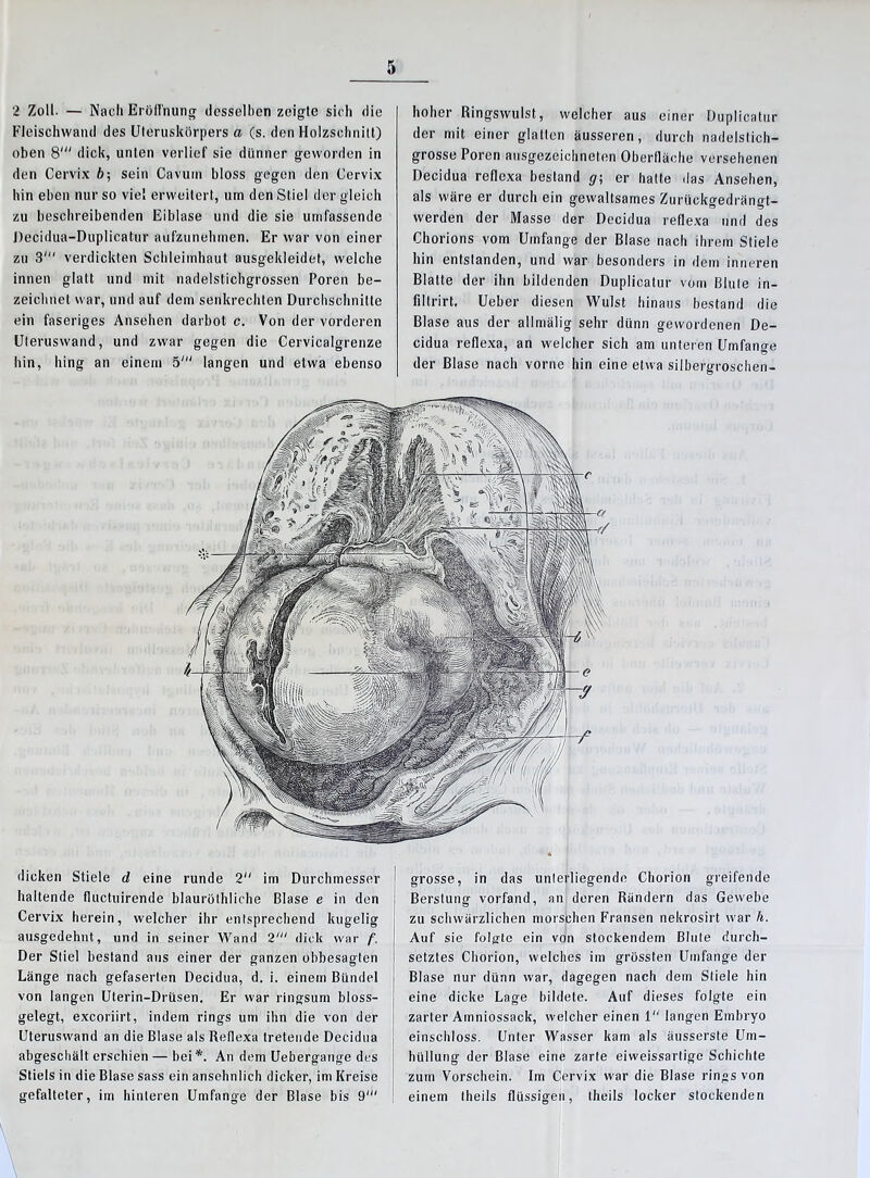 2 Zoll. — Nach Eröffnung desselben zeigte sich die Fleischwand des Uleruskörpers a (s. den Holzschnitt) oben 81 dick, unten verlief sie dünner geworden in den Cervix ft; sein Cavum bloss gegen den Cervix hin eben nur so viel erweitert, um den Stiel der gleich zu beschreibenden Eiblase und die sie umfassende Decidua-Duplicatur aufzunehmen. Er war von einer zu 3' verdickten Schleimhaut ausgekleidet, welche innen glatt und mit nadelstichgrossen Poren be- zeichnet war, und auf dem senkrechten Durchschnitte ein faseriges Ansehen darbot c. Von der vorderen Uteruswand, und zwar gegen die Cervicalgrenze hin, hing an einem 5' langen und etwa ebenso hoher Ringswulst, welcher aus einer Duplicatur der mit einer glatten äusseren, durch nadelstich- grosse Poren ausgezeichneten Oberfläche versehenen Decidua reflexa bestand g\ er hatte das Ansehen, als wäre er durch ein gewaltsames Zurückgedrängt- werden der Masse der Decidua reflexa und des Chorions vom Umfange der Blase nach ihrem Stiele hin entstanden, und war besonders in dem inneren Blatte der ihn bildenden Duplicatur vom Blute in- filtrirt. Ueber diesen Wulst hinaus bestand die Blase aus der allmälig sehr dünn gewordenen De- cidua reflexa, an welcher sich am unteren Umfange der Blase nach vorne hin eine etwa silbergroschen- dicken Stiele d eine runde 2 im Durchmesser haltende fluctuirende blauröthliche Blase e in den Cervix herein, welcher ihr entsprechend kugelig ausgedehnt, und in seiner Wand 2' dick war f. Der Stiel bestand aus einer der ganzen obbesagten Länge nach gefaserten Decidua, d. i. einem Bündel von langen Uterin-Drüsen. Er war ringsum bloss- gelegt, exeoriirt, indem rings um ihn die von der Uteruswand an die Blase als Reflexa tretende Decidua abgeschält erschien — bei *. An dem Uebergange des Stiels in die Blase sass ein ansehnlich dicker, im Kreise gefalteter, im hinteren Umfange der Blase bis 9' grosse, in das unterliegende Chorion greifende Berslung vorfand, an deren Rändern das Gewebe zu schwärzlichen morschen Fransen nekrosirt war h. Auf sie folgte ein von stockendem Blute durch- setztes Chorion, welches im grössten Umfange der Blase nur dünn war, dagegen nach dem Stiele hin eine dicke Lage bildete. Auf dieses folgte ein zarter Amniossaek, welcher einen 1 langen Embryo einschloss. Unter Wasser kam als äusserste Um- hüllung der Blase eine zarte eiweissartige Schichte zum Vorschein. Im Cervix war die Blase rings von einem Iheils flüssigen, theils locker stockenden