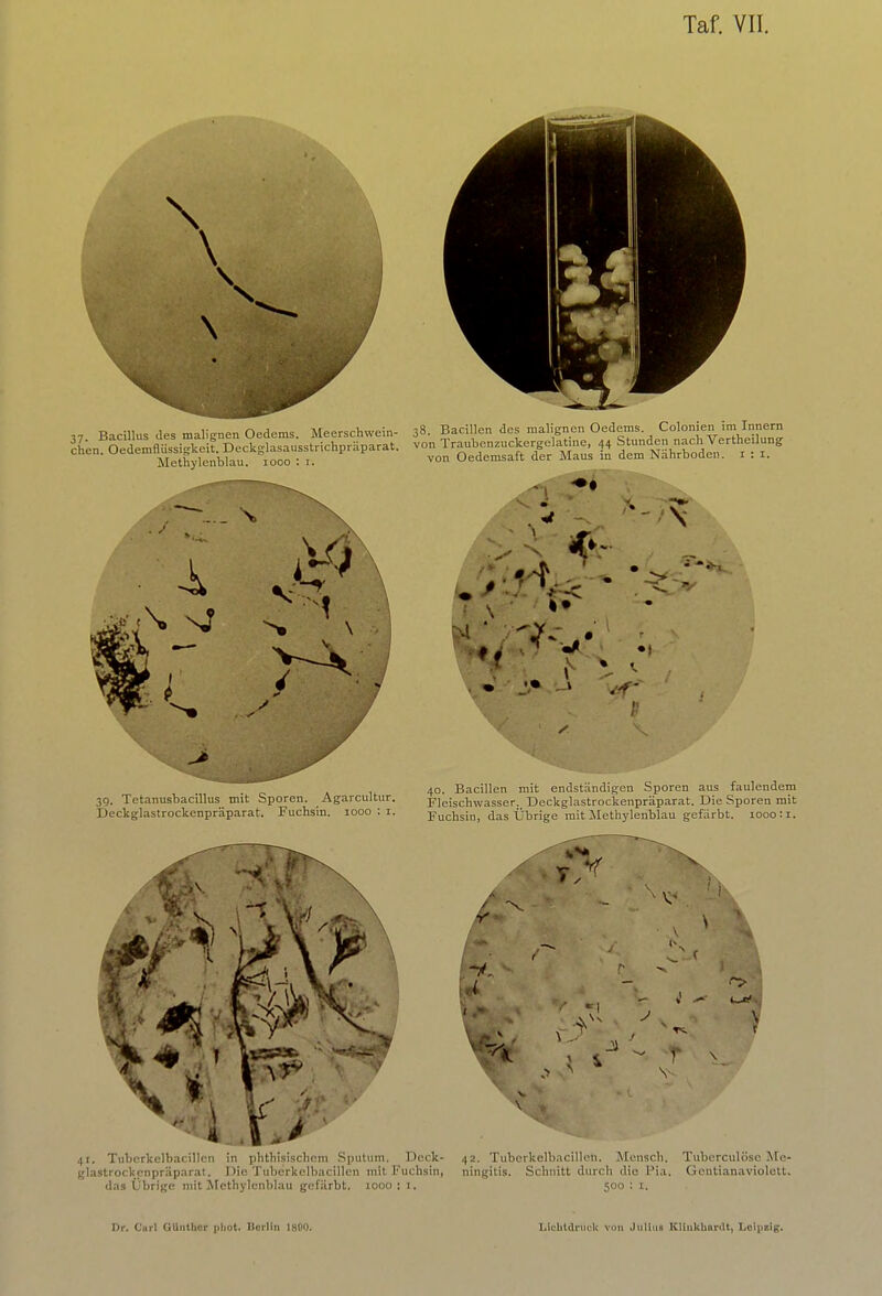 \ \ 37. Bacillus des malignen Oedems. Meerschwein- chen. Oedemflüssigkeit. Deckglasausstrichpräparat. Methylenblau, iooo : i. 38. Bacillen des malignen Oedems. Colonien im Innern von Traubcnzuckergelatine, 44 Stunden nach Vertheilung von Oedemsaft der Maus in dem Nährboden. 1 : 1. N '»TL.. /rf 39. Tetanusbacillus mit Sporen. Agarcultur. Deckglastrockenpräparat. Fuchsin. 1000 : 1. 40. Bacillen mit endständigen Sporen aus faulendem Fleischwasser:- Deckglastrockenpräparat. Die Sporen mit Fuchsin, das Übrige mit Methylenblau gefärbt. 1000:1. 41. Tubcrkelbacillcn in phthisischem Sputum. Dcck- glastrockcnpräpnrat. Die Tubcrkelbacillcn mit Fuchsin, das Übrige mit Methylenblau gefärbt. 1000: 1. V- 42. Tuberkelbacilleti. Mensch. Tuberculöse Me- ningitis. Schnitt durch die Pia. Gentianaviolett. 500 : 1.