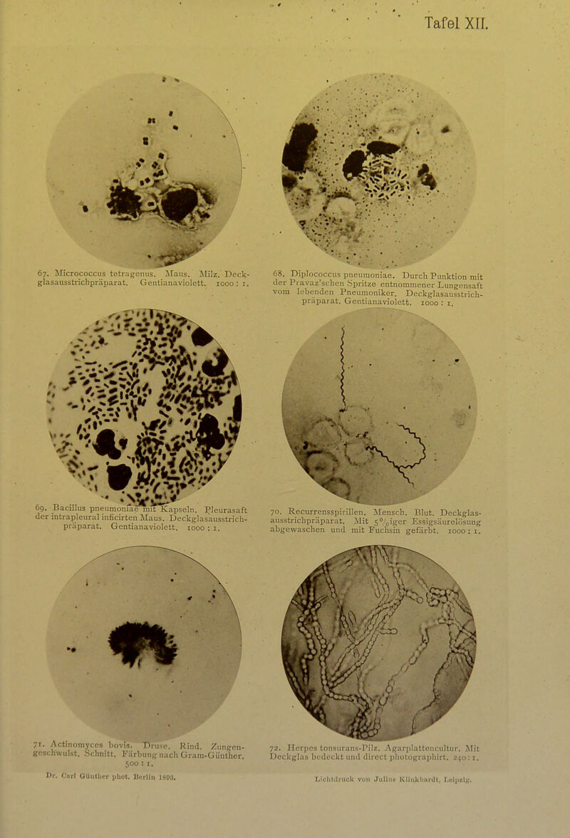 » % 67. Micrococcus tetragenus. Maus. Milz. Deck- glasausstrichpräparat. Gentianaviolett. 1000: 1. 71. Actinomyces bovis. Tlnuc. Rind. Zungen- geschwul.st. Schnitt. Färbung nach Gram-Günthcr. 500 : 1. 68. Diplococcus pneumoniae. Durch Punktion mit der Pravaz'schen Spritze entnommener Lungensaft vom lebenden Pneumoniker. Deckglasausstrich- präparat. Gentianaviolett. 1000 : 1. 70. Recurrensspirillen. Mensch. Blut. Deckglas- ausstrichpräparat. Mit 5°0iger Essigsäurelösung abgewaschen und mit Fuchsin gefärbt. 1000:1. 72. Herpcs tonstirans-Pilz. Agarplattencultur, Mit Deckglas bedeckt und direct photographirt. 2.|o: 1.