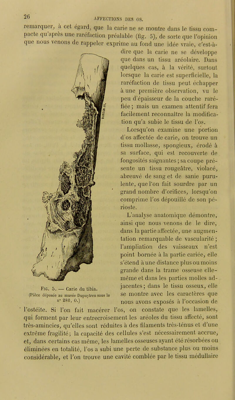 remarquer, à cet égard, que la carie ne se montre dans le tissu com- pacte qu'après une raréfaction préalable (fig. 5), de sorte que l'opinion que nous venons de rappeler exprime au fond une idée vraie, c'est-à- dire que la carie ne se développe que dans un tissu aréolaire. Dans quelques cas, à la vérité, surtout lorsque la carie est superficielle, la raréfaction de tissu peut échapper à une première observation, vu le peu d'épaisseur de la couche raré- fiée ; mais un examen attentif fera facilement reconnaître la modifica- tion qu'a subie le tissu de l'os. Lorsqu'on examine une portion d'os affectée de carie, on trouve un tissu mollasse, spongieux, érodé à sa surface, qui est recouverte de fongosités saignantes ; sa coupe pré- sente un tissu rougeâtre, violacé, abreuvé de sang et de sanie puru- lente, que l'on fait sourdre par un grand nombre d'orifices, lorsqu'on comprime l'os dépouillé de son pé- rioste. L'analyse anatomique démontre, ainsi que nous venons de le dire, dans la partie affectée, une augmen- tation remarquable de vascularité ; l'ampliation des vaisseaux n'est point bornée à la partie cariée, elle s'étend à une distance plus ou moins grande dans la trame osseuse elle- même et dans les parties molles ad- jacentes; dans le tissu osseux, elle se montre avec les caractères que nous avons exposés à l'occasion de l'ostéite. Si l'on fait macérer l'os, on constate que les lamelles, qui forment par leur entrecroisement les aréoles du tissu affecté, sont très-amincies, qu'elles sont réduites à des filaments très-ténus et d'une extrême fragilité; la capacité des cellules s'est nécessairement accrue, et, dans certains cas même, les lamelles osseuses ayant été résorbées ou éliminées en totalité, l'os a subi une perte de substance plus ou moins considérable, et l'on trouve une cavité comblée par le tissu médullaire Fig. 5. — Carie du tibia. (Pièce déposée au musée Dupuj tren sous le n° 280, 0.)