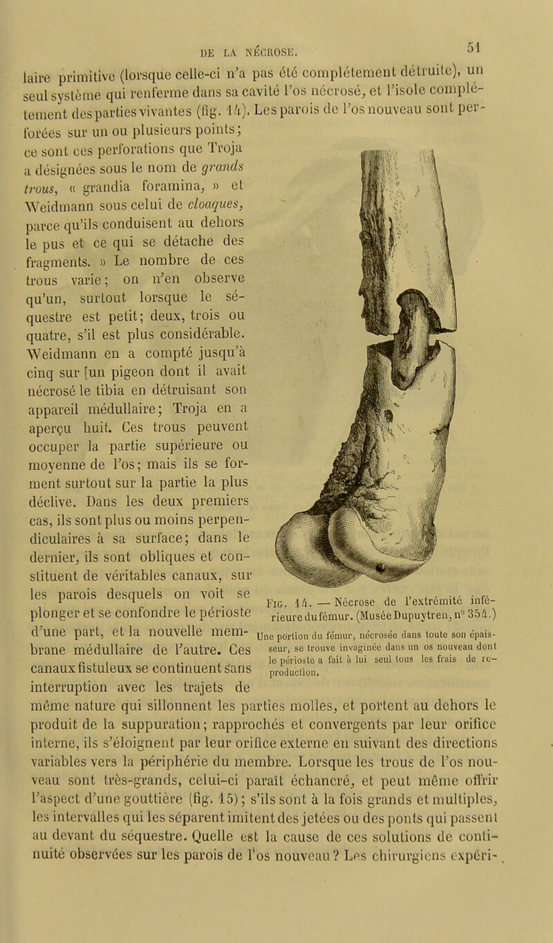 laire primitive (lorsque celle-ci n'a pas été complètement détruite), un seul système qui renferme dans sa cavité l'os nécrosé, et l'isole complè- tement des parties vivantes (fig. U). Les parois de l'os nouveau sont per- forées sur un ou plusieurs points; ce sont ces perforations que Troja a désignées sous le nom de grands trous, « grandia foramina, » et Weidtnann sous celui de cloaques, parce qu'ils conduisent au dehors le pus et ce qui se détache des fragments. » Le nombre de ces trous varie; on n'en observe qu'un, surtout lorsque le sé- questre est petit; deux, trois ou quatre, s'il est plus considérable. Weidmann en a compté jusqu'à cinq sur (un pigeon dont il avait nécrosé le tibia en détruisant son appareil médullaire; Troja en a aperçu huit. Ces trous peuvent occuper la partie supérieure ou moyenne de l'os ; mais ils se for- ment surtout sur la partie la plus déclive. Dans les deux premiers cas, ils sont plus ou moins perpen- diculaires à sa surface; dans le dernier, ils sont obliques et con- stituent de véritables canaux, sur les parois desquels on voit se plonger et se confondre le périoste d'une part, et la nouvelle mem- brane médullaire de l'autre. Ces canaux fistuleux se continuent Sans interruption avec les trajets de même nature qui sillonnent les parties molles, et portent au dehors le produit de la suppuration ; rapprochés et convergents par leur orifice interne, ils s'éloignent par leur orifice externe en suivant des directions variables vers la périphérie du membre. Lorsque les trous de l'os nou- veau sont très-grands, celui-ci paraît échancré, et peut même offrir l'aspect d'une gouttière (fig. 15); s'ils sont à la fois grands et multiples, les intervalles qui les séparent imitent des jetées ou des ponts qui passent au devant du séquestre. Quelle est la cause de ces solutions de conti- nuité observées sur les parois de l'os nouveau? Les chirurgiens expéri- FiGi —Nécrose de l'extrémité infé- rieure du fémur. (Musée Dupuytren,n0 354.) Une portion du fémur, nécrosée dans toute son épais- seur, se trouve invàginée dans un os nouveau dont le périoste a fait à lui seul tous les frais de re- production.